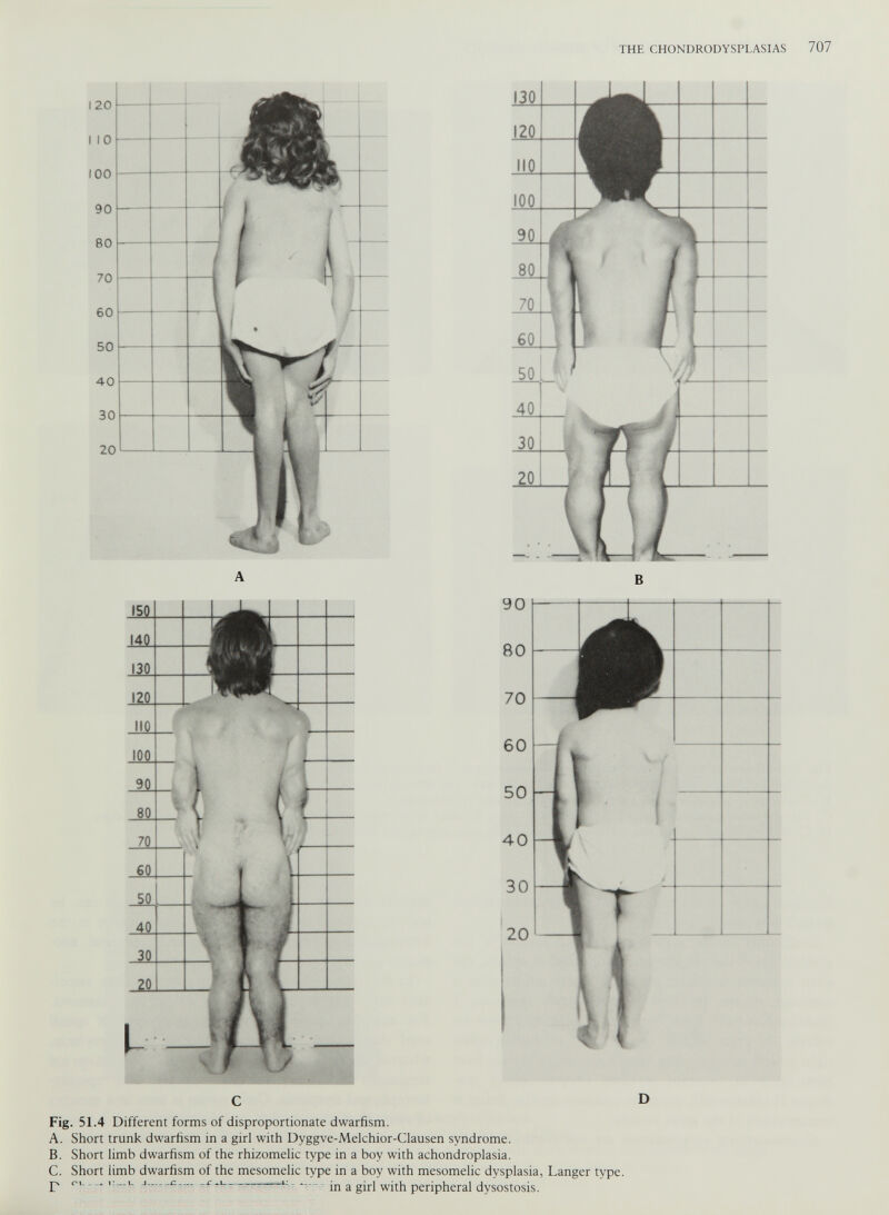 Fig. 51.4 Different forms of disproportionate dwarfism. A. Short trunk dwarfism in a girl with Dvggve-Melchior-Clausen syndrome. B. Short limb dwarfism of the rhizomelic type in a boy with achondroplasia. C. Short limb dwarfism of the mesomelic type in a boy with mesomelic dysplasia, Langer type, p j -c ^ ii ..... - n a gj r j pej-jpherai dysostosis.