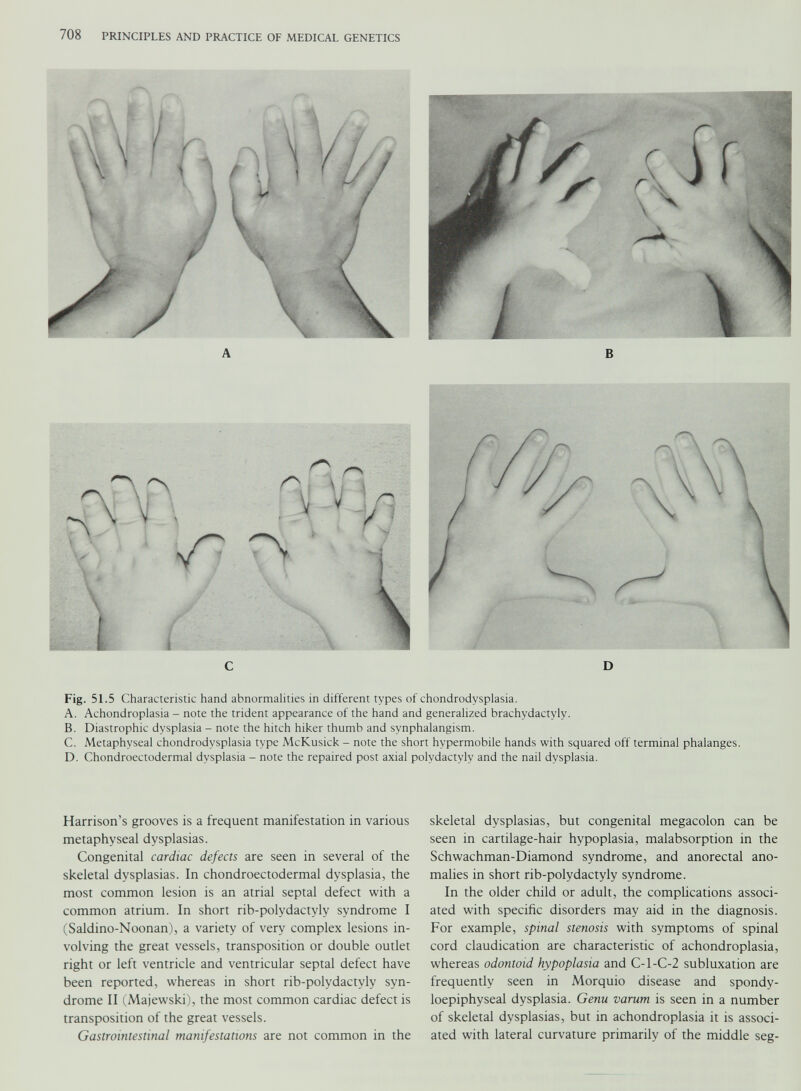 Fig. 51.5 Characteristic hand abnormalities in different types of chondrodysplasia. A. Achondroplasia - note the trident appearance of the hand and generalized brachvdactyly. B. Diastrophic dysplasia - note the hitch hiker thumb and synphalangism. C. Metaphyseal chondrodysplasia type McKusick - note the short hvpermobile hands with squared off terminal phalanges. D. Chondroectodermal dysplasia - note the repaired post axial polydactyly and the nail dysplasia. Harrison’s grooves is a frequent manifestation in various metaphyseal dysplasias. Congenital cardiac defects are seen in several of the skeletal dysplasias. In chondroectodermal dysplasia, the most common lesion is an atrial septal defect with a common atrium. In short rib-polydactyly syndrome I (Saldino-Noonan), a variety of very complex lesions in volving the great vessels, transposition or double outlet right or left ventricle and ventricular septal defect have been reported, w r hereas in short rib-polydactyly syn drome II (Majewski), the most common cardiac defect is transposition of the great vessels. Gastrointestinal manifestations are not common in the skeletal dysplasias, but congenital megacolon can be seen in cartilage-hair hypoplasia, malabsorption in the Schwachman-Diamond syndrome, and anorectal ano malies in short rib-polydactyly syndrome. In the older child or adult, the complications associ ated with specific disorders may aid in the diagnosis. For example, spinal stenosis with symptoms of spinal cord claudication are characteristic of achondroplasia, whereas odontoid hypoplasia and C-l-C-2 subluxation are frequently seen in Morquio disease and spondy loepiphyseal dysplasia. Genu varum is seen in a number of skeletal dysplasias, but in achondroplasia it is associ ated with lateral curvature primarily of the middle seg-