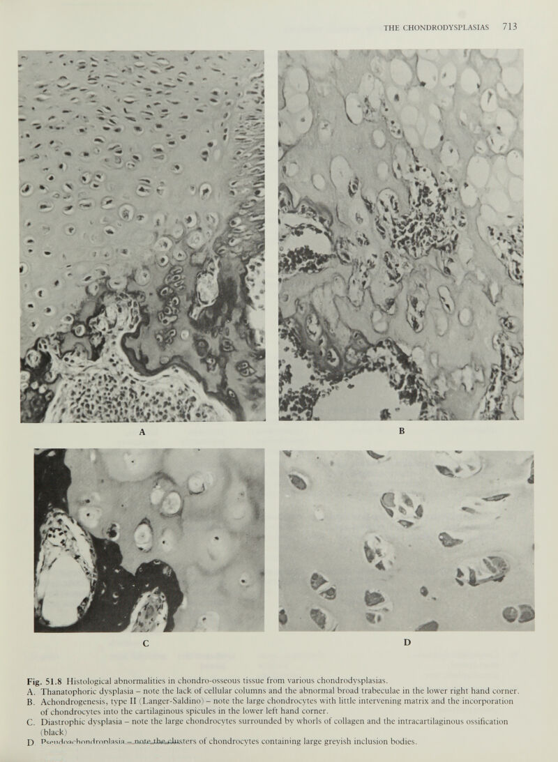 Fig. 51.8 Histological abnormalities in chondro-osseous tissue from various chondrodysplasias. A. Thanatophoric dysplasia - note the lack of cellular columns and the abnormal broad trabeculae in the lower right hand corner. B. Achondrogenesis, type II (Langer-Saldino) - note the large chondrocytes with little intervening matrix and the incorporation of chondrocytes into the cartilaginous spicules in the lower left hand corner. C. Diastrophic dysplasia - note the large chondrocytes surrounded by whorls of collagen and the intracartilaginous ossification (black) D PepiiHnorhnnrlrnnlasia - ruxteJ.h/u.U esters of chondrocytes containing large greyish inclusion bodies.