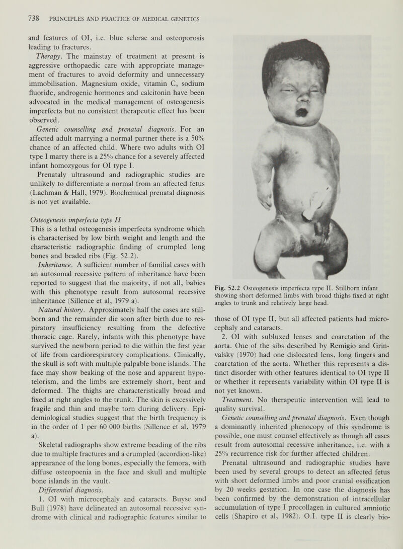 and features of 01, i.e. blue sclerae and osteoporosis leading to fractures. Therapy. The mainstay of treatment at present is aggressive orthopaedic care with appropriate manage ment of fractures to avoid deformity and unnecessary immobilisation. Magnesium oxide, vitamin C, sodium fluoride, androgenic hormones and calcitonin have been advocated in the medical management of osteogenesis imperfecta but no consistent therapeutic effect has been observed. Genetic counselling and prenatal diagnosis. For an affected adult marrying a normal partner there is a 50% chance of an affected child. Where two adults with 01 type I marry there is a 25% chance for a severely affected infant homozygous for 01 type I. Prenataly ultrasound and radiographic studies are unlikely to differentiate a normal from an affected fetus (Lachman & Hall, 1979). Biochemical prenatal diagnosis is not yet available. Osteogenesis imperfecta type II This is a lethal osteogenesis imperfecta syndrome which is characterised by low birth weight and length and the characteristic radiographic finding of crumpled long bones and beaded ribs (Fig. 52.2). Inheritance. A sufficient number of familial cases with an autosomal recessive pattern of inheritance have been reported to suggest that the majority, if not all, babies with this phenotype result from autosomal recessive inheritance (Sillence et al, 1979 a). Natural history. Approximately half the cases are still born and the remainder die soon after birth due to res piratory insufficiency resulting from the defective thoracic cage. Rarely, infants with this phenotype have survived the newborn period to die within the first year of life from cardiorespiratory complications. Clinically, the skull is soft with multiple palpable bone islands. The face may show beaking of the nose and apparent hypo- telorism, and the limbs are extremely short, bent and deformed. The thighs are characteristically broad and fixed at right angles to the trunk. The skin is excessively fragile and thin and maybe torn during delivery. Epi demiological studies suggest that the birth frequency is in the order of 1 per 60 000 births (Sillence et al, 1979 a). Skeletal radiographs show extreme beading of the ribs due to multiple fractures and a crumpled (accordion-like) appearance of the long bones, especially the femora, with diffuse osteopoenia in the face and skull and multiple bone islands in the vault. Differential diagnosis. 1. 01 with microcephaly and cataracts. Buyse and Bull (1978) have delineated an autosomal recessive syn drome with clinical and radiographic features similar to Fig. 52.2 Osteogenesis imperfecta type II. Stillborn infant showing short deformed limbs with broad thighs fixed at right angles to trunk and relatively large head. those of 01 type II, but all affected patients had micro cephaly and cataracts. 2. 01 with subluxed lenses and coarctation of the aorta. One of the sibs described by Remigio and Grin- valsky (1970) had one dislocated lens, long fingers and coarctation of the aorta. Whether this represents a dis tinct disorder with other features identical to 01 type II or whether it represents variability within 01 type II is not yet known. Treatment. No therapeutic intervention will lead to quality survival. Genetic counselling and prenatal diagnosis. Even though a dominantly inherited phenocopy of this syndrome is possible, one must counsel effectively as though all cases result from autosomal recessive inheritance, i.e. with a 25% recurrence risk for further affected children. Prenatal ultrasound and radiographic studies have been used by several groups to detect an affected fetus with short deformed limbs and poor cranial ossification by 20 weeks gestation. In one case the diagnosis has been confirmed by the demonstration of intracellular accumulation of type I procollagen in cultured amniotic cells (Shapiro et al, 1982). O.I. type II is clearly bio