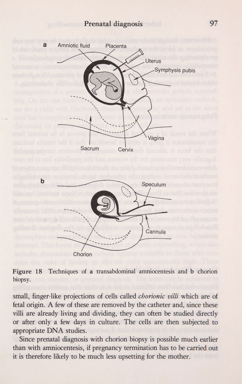 Prenatal diagnosis 97 Figure 18 Techniques of a transabdominal amniocentesis and b chorion biopsy. small, finger-like projections of cells called chorionic villi which are of fetal origin. A few of these are removed by the catheter and, since these villi are already living and dividing, they can often be studied directly or after only a few days in culture. The cells are then subjected to appropriate DNA studies. Since prenatal diagnosis with chorion biopsy is possible much earlier than with amniocentesis, if pregnancy termination has to be carried out it is therefore likely to be much less upsetting for the mother.