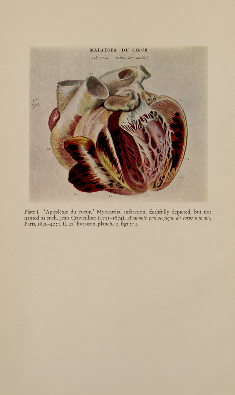 MALADIES DU CŒUR / dpophww. 2 Jnevrwt/te par/te/. Plate I ' Apopléxie du coeur. ' Myocardial infarction, faithfully depicted, but not named as such. Jean Cruveilhier (1791-1874), Anatomie pathologique du corps humain, Paris, 1829-42; t. II, 22 o livraison, planche 3, figure i.