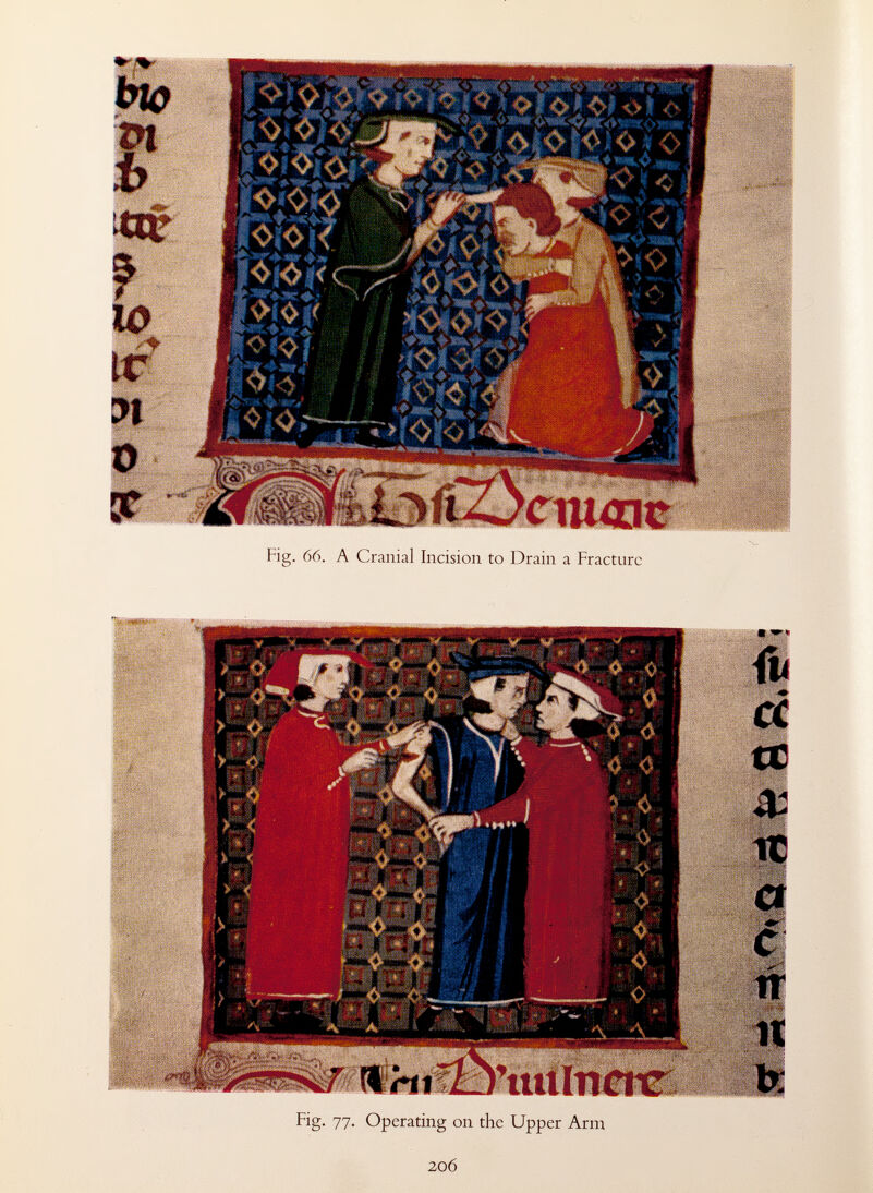 Fig. 66. A Cranial Incision to Drain a Fracture 1 m »• St? • 4 •-r¿f¿i¡ P^fVr J ^frTlKMÍ y~- - - p ■y* W ^^Mm /mWÊk n 1st i !?♦■»♦» inf QH HHH ¡PÍB^SHWí 1 ... j' * -i- {u 1 cc X .  „' ÎÈ m -.». Kxl I 1? JEM , H HI (p^i^ï NÏ ■ 1 1 HÍÍÍÍP m Bp |F4^^ 3RjlÉ3*® 1 !® ! et i ' i*? il L H »'rtifö'iullneitr. ^ - * ™ b; Fig. 77. Operating on the Upper Arm 206