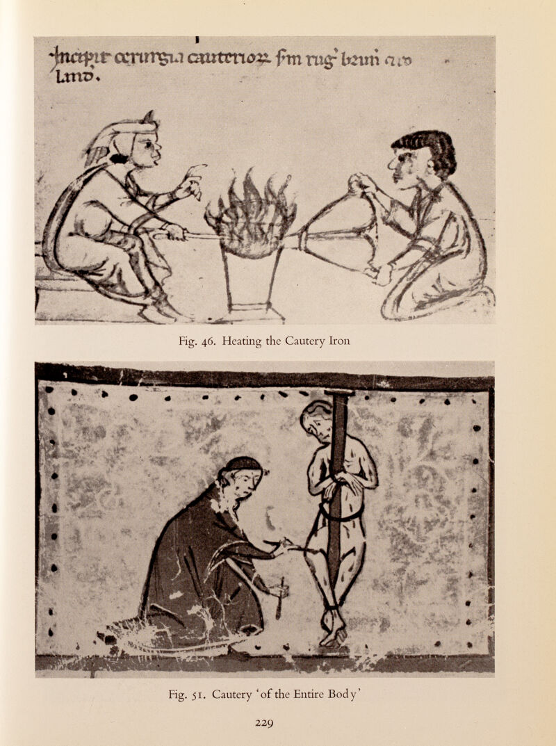 4ttà}*tf ccnrrçu ernten#fm rugr torn a m Um?» Fig. 46. Heating the Cautery Iron Fig. 51. Cautery 'of the Entire Body'