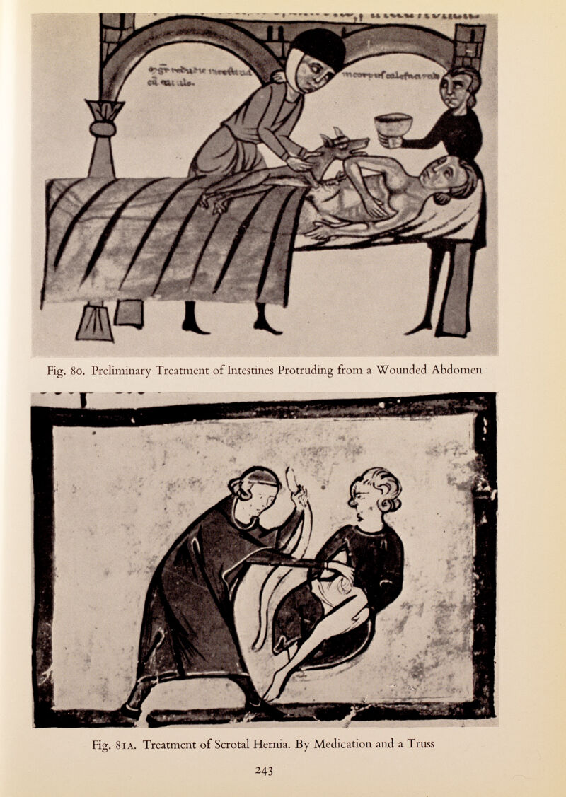 Fig. 80. Preliminary Treatment of Intestines Protruding from a Wounded Abdomen Fig. 81 a. Treatment of Scrotal Hernia. By Medication and a Truss