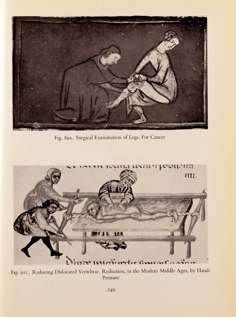 Fig. 89A. Surgical Examination of Legs. For Cancer Fig. 91 c. Reducing Dislocated Vertebrae. Reduction, in the Moslem Middle Ages, by Hand- Pressure