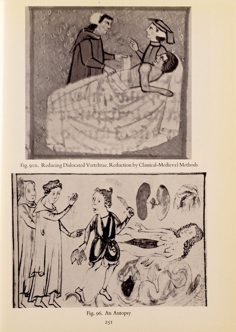 Fig. 91D. Reducing Dislocated Vertebrae. Reduction by Classical-Medieval Methods Fig. 96. An Autopsy