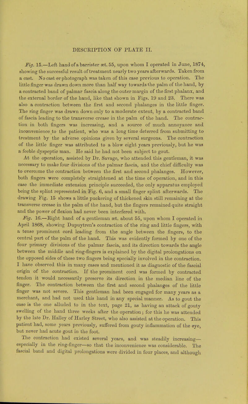 Fig. 15.—Left liand of a barrister set. 55, upon whom I operated in June, 1874, showing the successful result of treatment nearly two years afterwards. Taken from a cast. No cast or photograph was taken of this case previous to operation. The little finger was drawn down more than half way towards the palm of tlie hand, by a contracted band of palmar fascia along the outer margin of the first phalanx, and the external border of the hand, like that shown in Pigs. 19 and 23. There was also a contraction between the first and second phalanges in the little finger. The ring finger was drawn down only to a moderate extent, by a contracted band of fascia leading to the transverse crease in the palm of the hand. The contrac- tion in both fingers was increasing, and a source of much annoyance and inconvenience to the patient, who was a long time deterred from submitting to treatment by the adverse opinions given by several surgeons. The contraction of the little finger was attributed to a blow eight years previously, but he was a feeble dyspeptic man. He said he had not been subject to gout. At the operation, assisted by Dr. Savage, who attended this gentleman, it was necessary to make four divisions of the palmar fascia, and the chief difficulty was to overcome the contraction between the fii-st and second phalanges. However, both fingers were completely straightened at the time of operation, and in tliis case the immediate extension principle succeeded, the only apparatus employed being the splmt represeinted in Fig. 6, and a small finger splint afterwards. The drawing Fig. 15 shows a little puckering of thickened skin still remaining at the transverse crease in the palm of tlie hand, but the fingers remained quite straight and the power of flexion had never been interfered with. Fig. 16.—Right hand of a gentleman £Et. about 55, upon whom I operated in April 1868, showing Dupuytren's contraction of the ring and little fingers, with a tense prominent cord leading from the angle between the fingers, to the central part of the palm of the hand. Tliis was evidently formed by one of the four primary divisions of the palmar fascia, and its direction towards the angle between the middle and ring-fingers is explained by the digital prolongations on the opposed sides of these two fingers being specially involved in the contraction. I have observed this in many cases and mentioned it as diagnostic of the fascial origin of the contraction. If the prominent cord was formed by contracted tendon it would necessarily preserve its direction in the median line of the finger. The contraction between the first and second phalanges of the little finger was not severe. This gentleman had been engaged for many years as a merchant, and had not used this hand in any special manner. As to gout the case is the one alluded to in the text, page 21, as having an attack of gouty swelling of the hand three weeks after the operation; for this he was attended by the late Dr. Ilalley of Harley Street, who also assisted at the operation. This patient had, some years previously, sufiPered from gouty inflammation of the eye, but never had acute gout in the foot. The contraction had existed several years, and was steadily increasing— especially in the ring-finger—so that the inconvenience was considerable. The fascial baud and digital ])rolongation8 were divided in four places, and although