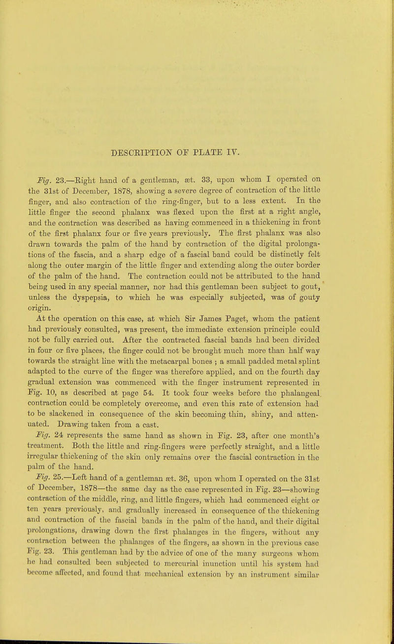 Fig. 23.—Right hand of a gentleman, set. 33, upon whom I operated on the 31st of December, 1878, showing a severe degree of contraction of the httle finger, and also contraction of the ring-finger, but to a less extent. In the little finger the second phalanx was flexed upon the first at a riglit angle, and the contraction was described as having commenced in a thickening in front of the first phalanx four or five years previously. The first phalanx was also drawn towards the palm of the hand by contraction of the digital prolonga- tions of the fascia, and a sharp edge of a fascial band could be distinctly felt along the outer margin of the little finger and extending along the outer border of the palm of the hand. The contraction could not be attributed to the hand being used in any special manner, nor had this gentleman been subject to gout, unless the dyspepsia, to which he was especially subjected, was of gouty origin. At the operation on this case, at which Sir James Paget, whom the patient had previously consulted, was present, the immediate extension principle could not be fully carried out. After the contracted fascial bands had been divided in four or five places, the finger could not be brought much more than half way towards the straight line with the metacarpal bones ; a small padded metal splint adapted to the curve of the finger was therefore apphed, and on the foui-th day gradual extension was commenced with the finger instrument represented in Fig. 10, as described at page 54. It took four weeks before the phalangeal, contraction could be completely overcome, and even this rate of extension had to be slackened in consequence of the skin becoming thin, shiny, and atten- uated. Drawing taken from a cast. Fig. 24 represents the same hand as shown in Fig. 23, after one month's treatment. Both the little and ring-fingers were perfectly straight, and a little irregular thickening of the skin only remains over the fascial contraction in the palm of the hand. Fig. 25.—Left hand of a gentleman rot. 36, upon whom I operated on the 3l8t of December, 1878—the same day as the case represented in Fig. 23—showing contraction of the middle, ring, and little fingers, which had commenced eight or ten years previously, and gradually increased in consequence of the thickening and contraction of the fascial bands in tlie palm of tlio hand, and their digital prolongations, drawing down the first phalanges in the fingers, without any contraction between the phalanges of the fingers, as shown in the previous case Fig. 23. This gentleman had by the advice of one of the many siu-geons whom he had consulted been subjected to mercurial inunction until his system had become affected, and found tliat mechanical extension by an instrument similar