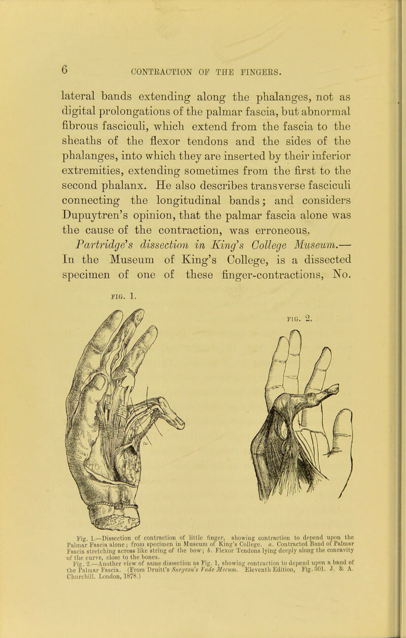 lateral bands extending along the phalanges, not as digital prolongations of the palmar fascia, but abnormal fibrous fasciculi, which extend from the fascia to the sheaths of the flexor tendons and the sides of the phalanges, into which they are inserted by their inferior extremities, extending sometimes from the first to the second phalanx. He also describes transverse fasciculi connecting the longitudinal bands; and considers Dupuytren's opinion, that the palmar fascia alone was the cause of the contraction, was erroneous. Partridge^s dissection in King's College Museum.— In the Museum of King's College, is a dissected specimen of one of these finger-contractions. No. JIG. 1. Yif, 1.—Dissection of contnictiou of little finger, sliowiiii; uoiiti'HClioii to drnend u|iou the Piiliimr I'nscia alone; from specimen in Museum ot Kinji's ColIc(,'e. a. Conlracted Bimd ol Palmar Fascia stretching across like string of tlie liow; I/. Flexor Tendons lying deeply along the concavity of tlie curve, close to the bones. Fig. 2.—Another view of same dissection as Fig. 1, showing eonlnictinn to depend upon a hand of the Palmar Fascia, (^rom Druill'B Surgeon's fade Mcciwi. Eleveutli Kdition, Fig. .SOI. J. & A. Churchill. London, 1878.)