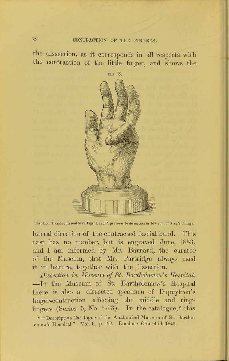 the dissection, as it corresponds in all respects with the contraction of the httle finger, and shows the FIG. 3. Cast from Hand represented in Kgs. 1 and 2, previous to dissection in Museum of King's College. lateral direction of the contracted fascial band. This cast has no number, but is engraved June, 1853, and I am informed by Mr. Barnard, the curator of the Museum, that Mr. Partridge always used it in lecture, together with the dissection. Dissection in Museum of St. Bartholomew^s Hospital. —In the Museum of St. Bartholomew's Hospital there is also a dissected specimen of Dupuytren's finger-contraction affecting the middle and ring- fingers (Series 5, 'No. 5-23). In the catalogue,* this *  Descriptive Catalogue of the Anatomical Museum of St. Bartho- lomew's Hospital. Vol. I., p. 192. London : Churchill, 1846.