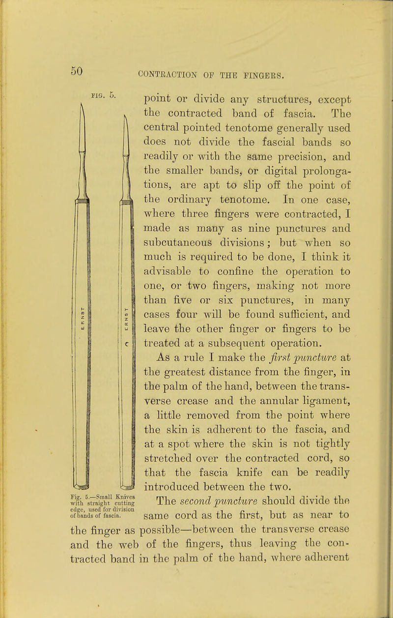 5. point or divide any structures, except the contracted band of fascia. Tbe central pointed tenotome generally used does not divide the fascial bands so readily or with the same precision, and the smaller bands, or digital prolonga- tions, are apt to slip off the point of the ordinary tenotome. In one case, where three fingers were contracted, I made as many as nine punctures and subcutaneous divisions; but when so much is required to be done, I think it advisable to confine the operation to one, or two fingers, making not more than five or six punctures, in many cases four will be found sufficient, and leave the other finger or fingers to be treated at a subsequent operation. As a rule I make the firf^t puncture at the greatest distance from the finger, in the palm of the hand, between the trans- verse crease and the annular ligament, a little removed from the point where the skin is adherent to the fascia, and at a spot where the skin is not tightly stretched over the contracted cord, so that the fascia knife can be readily introduced between the two. The second puncture should divide the same cord as the first, but as near to the finger as possible—between the transverse crease and the web of the fingers, thus leaving the con- tracted band in the palm of the hand, where adherent rig. 5.—Small Knives with straight cutting edge, used lor division of bands of fascia. t