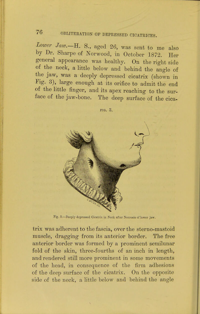Lower Jaw.-B.. S., aged 26, was sent to me also by Dr. Sharpe of Norwood, in October 1872. Her general appearance was healthy. On the right side of the neck, a little below and behind the angle of the jaw, was a deeply depressed cicatrix (shown in Mg. 3), large enough at its orifice to admit the end of the little finger, and its apex reaching to the sur- face of the jaw-bone. The deep surface of the cica- FIG. 3. Fig. 3.—Deeply depressed Cicatrix in Neck after Necrosis of lower jaw. trix was adherent to the fascia, over the sterno-mastoid muscle, dragging from its anterior border. The free anterior border was formed by a prominent semilunar fold of the skin, three-fourths of an inch in length, and rendered still more prominent in some movements of the head, in consequence of the firm adhesions of the deep surface of the cicatrix. On the opposite side of the neck, a little below and behind the angle