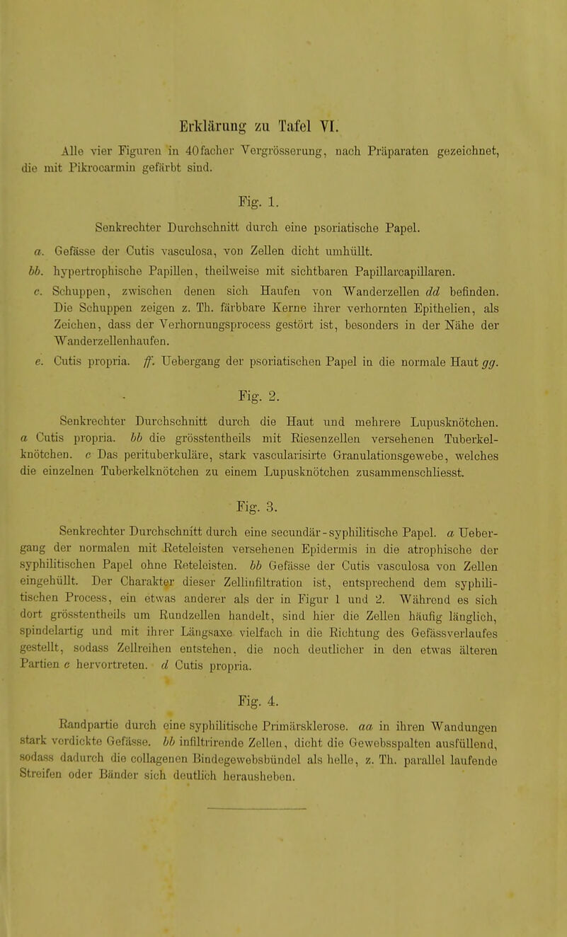 Alle vier Figuren in 40facher Vorgrösserung, nach Präparaten gezeichnet, die mit Pikrocarmiu gefärbt sind. Fig. 1. Senkrechter Durchschnitt durch eine psoriatische Papel. a. Gefässe der Cutis vasculosa, von Zellen dicht umhüllt. bb. hypertrophische Papillen, theilweise mit sichtbaren Papillarcapillaren. c. Schuppen, zwischen denen sich Haufen von Wanderzellen dd befinden. Die Schuppen zeigen z. Th. färbbare Kerne ihrer verhornten Epithelien, als Zeichen, dass der Verhoruungsprocess gestört ist, besonders in der Nähe der Wanderzellenhaufen. e. Cutis propria. ff. TJebergang der psoriatischen Papel in die normale Haut gg. Fig. 2. Senkrechter Durchschnitt durch die Haut und mehrere Lupusknötchen. a Cutis propria. bb die grösstentheils mit Riesenzellen versehenen Tuberkel- knötchen. c Das perituberkuläre, stark vascularisirte Granulationsgewebe, welches die einzelnen Tuberkelknötchen zu einem Lupusknötchen zusammenschliesst. Fig. 3. Senkrechter Durchschnitt durch eine secundär-syphilitische Papel, a TJeber- gang der normalen mit Reteleisten versehenen Epidermis in die atrophische der syphilitischen Papel ohne Reteleisten. bb Gefässe der Cutis vasculosa von Zellen eingehüllt. Der Charakter dieser Zellinfiltratioa ist, entsprechend dem syphili- tischen Process, ein etwas anderer als der in Figur I und 2. Während es sich dort grösstentheils um Rundzollen handelt, sind hier die Zellen häufig länglich, spindelartig und mit ihrer Längsaxe vielfach in die Richtung des GefässVerlaufes gestellt, sodass Zellreihen entstehen, die noch deutlicher in den etwas älteren Partien e hervortreten, d Cutis propria. Fig. 4. Randpartie durch eine sypliilitische Primärsklerose, aa in ihren Wandungen stark vordickte Gefässe. bb infiltrirende Zellen, dicht die Gewebsspalten ausfüllend, sodass dadurch die coUagencn Bindcgewebsbündel als helle, z. Th. parallel laufende Streifen oder Bänder sich deutlich herausheben.