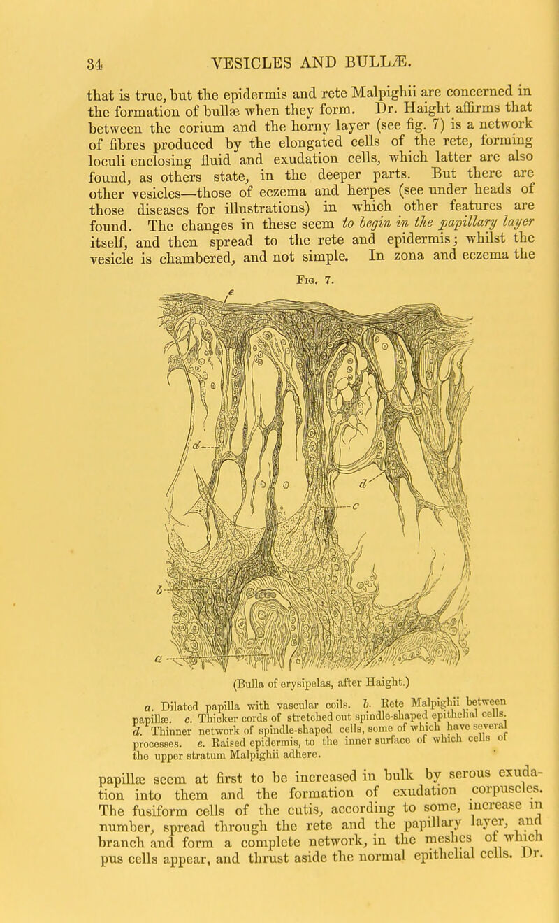 that is true, but the epidermis and rete Malpighii are concerned in the formation of bulte when they form. Dr. Haight affirms that between the corium and the horny layer (see fig. 7) is a network of fibres produced by the elongated cells of the rete, formmg loculi enclosing fluid and exudation cells, which latter are also found, as others state, in the deeper parts. But there are other vesicles—those of eczema and herpes (see under heads of those diseases for illustrations) in which other features are found. The changes in these seem io begin in the papillarij layer itself, and then spread to the rete and epidermis; whilst the vesicle is chambered, and not simple. In zona and eczema the Fig. 7. (Bulla of erysipelas, after Haight.) a. Dilated papilla with vascular coils. I- Rete Malpighn between papillse. c. Thicker cords of stretched out spindle-shaped epithelial cells. 3. Thinner network of spindle-shaped cells, some of which have several processes, c. Raised epidermis, to the inner surface of which cells ot the upper stratum Malpighii adhere. papillae seem at first to be increased in bulk by serous exuda- tion into them and the formation of exudation corpuscles. The fusiform cells of the cutis, according to some, increase in number, spread through the rete and the papillary layer, and branch and form a complete network, in the meshes ot which pus cells appear, and thrust aside the normal epithelial cells. Dr.