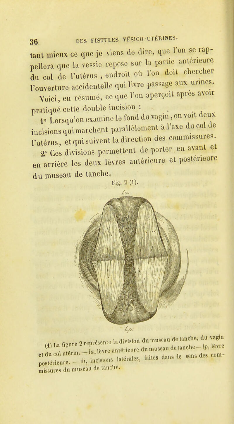 tant mieux ce que je viens de dire, que l'on se rap- pellera que la vessie repose sur la partie antérieure du col de l'ulérus , endroit où l'on doit chercher l'ouverture accidentelle qui livre passage aux urines. Voici, en résumé, ce que l'on aperçoit après avoir pratiqué cette double incision : 1» Lorsqu'on examine le fond du vagin, on voit deux incisions qui marchent parallèlement à l'axe du col de l'utérus, et qui suivent la direction des commissures 2» Ces divisions permettent de porter en avant et en arrière les deux lèvres antérieure et postérieure du museau de tanche. Ml La n.nve 2 représente la division du n^useau de tanche, du vagin i , ZI la Ifevre antérieure dunuiseau de.anche- Ip, lè^.e ;:::r---s .a,éra,es. ..es dans . sens des con. missures du museau de lanclie.