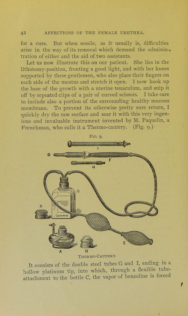 for a cure. But wheu sessile, as it' usually is, difficulties arise in the way of its removal which demand the adminis-. tration of either and the aid of. two assistants. Let us now illustrate this on our patient. She lies in the lithotomy-position, fronting a good light, and with her knees supported by these gentlemen, who also place their fingers on each side of the meatus and stretch it open. I now hook up the base of the growth with a uterine tenaculum, and snip it off by repeated clips of a pair of curved scissors. I take care to include also a portion of the surrounding healthy mucous membrane. To prevent its otherwise pretty sure return, I quickly dry the raw surface and sear it with this very ingen- ious and invaluable instrument invented by M. Paquelin, a Frenchman, who calls it a Thermo-cautery. (Fig. 9.) Fig. 9. A B Thermocautery. It consists of the double steel tubes G and I, ending in a hollow platinum tip, into which, through a flexible tube- attachment to the bottle C, the vapor of benzolme is forced ♦