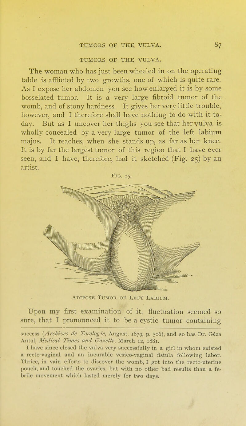 TUMORS OF THE VULVA. The woman who has just been wheeled in on the operating table is afflicted by two growths, one of which is quite rare. As I expose her abdomen you see how enlarged it is by some bosselated tumor. It is a very large fibroid tumor of the womb, and of stony hardness. It gives her very little trouble, however, and I therefore shall have nothing to do with it to- day. But as I uncover her thighs you see that her vulva is wholly concealed by a very large tumor of the left labium majus. It reaches, when she stands up, as far as her knee. It is by far the largest tumor of this region that I have ever seen, and I have, therefore, had it sketched (Fig. 25) by an artist. Fig. 25. Adipose Tumor of Left Labium. Upon my first examination of it, fluctuation seemed so sure, that I pronounced it to be a cystic tumor containing success (Archives de Tocologie, August, 1879, p. 506), aud so lias Dr. Geza Antal, Medical Times and Gazette, March 12, 1881. I have since closed the vulva very successfully in a girl in whom existed a recto-vaginal and an incurable vesico-vaginal fistula following labor. Thrice, in vain efforts to discover the womb, I got into the recto-uterine pouch, and touched the ovaries, but with no other bad results than a fe- brile movement which lasted merely for two days.