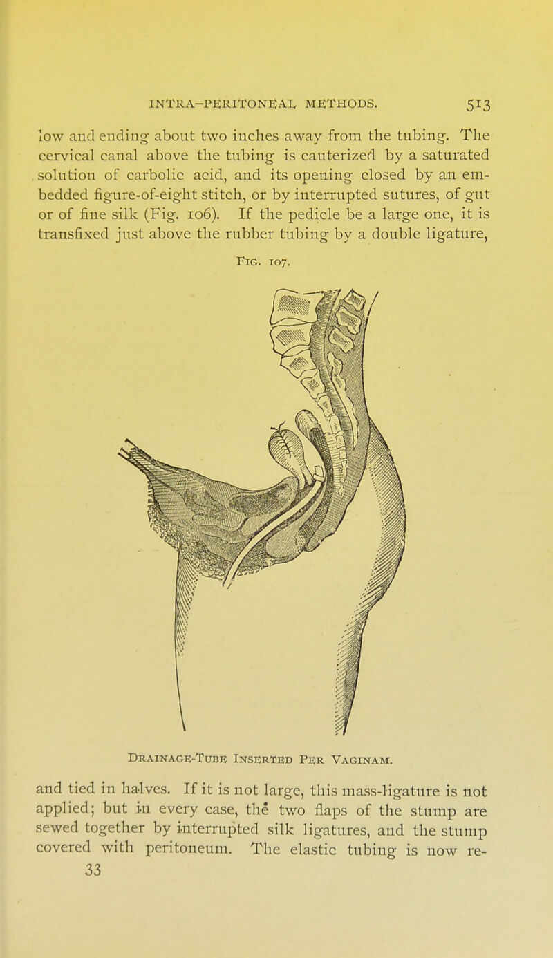 low and ending about two inches away from the tubing. The cervical canal above the tubing is cauterized by a saturated solution of carbolic acid, and its opening closed by an em- bedded figure-of-eight stitch, or by interrupted sutures, of gut or of fine silk (Fig. 106). If the pedicle be a large one, it is transfixed just above the rubber tubing by a double ligature, Fig. 107. Drainage-Tube Inserted Per Vaginam. and tied in halves. If it is not large, this mass-ligature is not applied; but in every case, the two flaps of the stump are sewed together by interrupted silk ligatures, and the stump covered with peritoneum. The elastic tubing is now re- 33