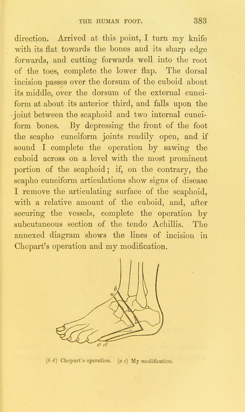 direction. Arrived at this point, I turn my knife with its flat towards the bones and its sharp edge forwards, and cutting forwards well into the root of the toes, complete the lower flap. The dorsal incision passes over the dorsum of the cuboid about its middle, over the dorsum of the external cunei- form at about its anterior third, and falls upon the joint between the scaphoid and two internal cunei- form bones. By depressing the front of the foot the scapho cuneiform joints readily open, and if sound I complete the operation by sawing the cuboid across on a level with the most prominent portion of the scaphoid; if, on the contrary, the scapho cuneiform articulations show signs of disease I remove the articulating surface of the scaphoid, vdth a relative amount of the cuboid, and, after securing the vessels, complete the operation by subcutaneous section of the tendo Achillis. The annexed diagram shows the lines of incision in Chopart's operation and my modification. (A d) Chopart's operation, {a c) My modification. < i