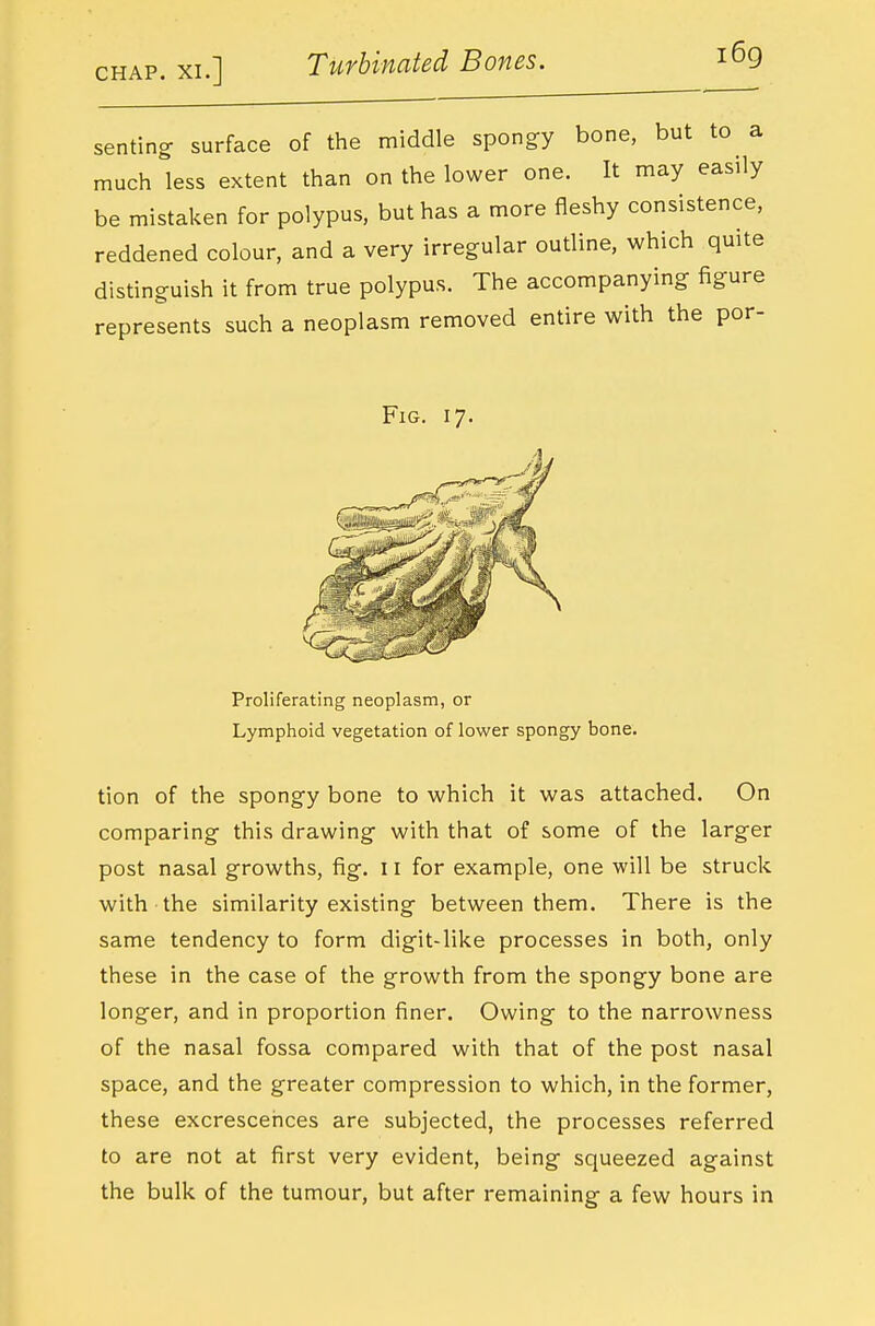 senting surface of the middle spongy bone, but to a much less extent than on the lower one. It may easily be mistaken for polypus, but has a more fleshy consistence, reddened colour, and a very irregular outline, which quite distinguish it from true polypus. The accompanying figure represents such a neoplasm removed entire with the por- FiG. 17. Proliferating neoplasm, or Lymphoid vegetation of lower spongy bone. tion of the spongy bone to which it was attached. On comparing this drawing with that of some of the larger post nasal growths, fig. 11 for example, one will be struck with the similarity existing between them. There is the same tendency to form digit-like processes in both, only these in the case of the growth from the spongy bone are longer, and in proportion finer. Owing to the narrowness of the nasal fossa compared with that of the post nasal space, and the greater compression to which, in the former, these excrescences are subjected, the processes referred to are not at first very evident, being squeezed against the bulk of the tumour, but after remaining a few hours in