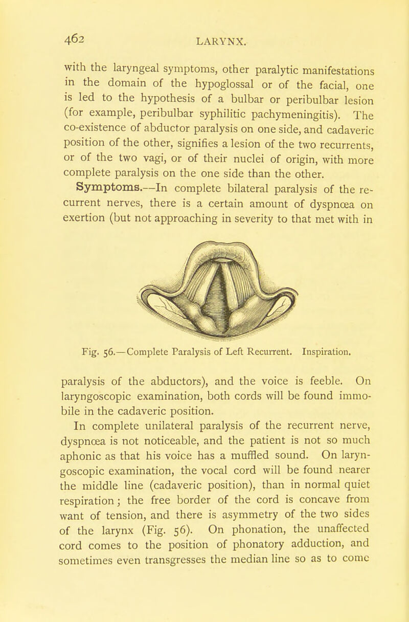 with the laryngeal symptoms, other paralytic manifestations in the domain of the hypoglossal or of the facial, one is led to the hypothesis of a bulbar or peribulbar lesion (for example, peribulbar syphilitic pachymeningitis). The co-existence of abductor paralysis on one side, and cadaveric position of the other, signifies a lesion of the two recurrents, or of the two vagi, or of their nuclei of origin, with more complete paralysis on the one side than the other. Symptoms.—In complete bilateral paralysis of the re- current nerves, there is a certain amount of dyspnoea on exertion (but not approaching in severity to that met with in Fig. 56.—Complete Paralysis of Left Recuirent. Inspiration. paralysis of the abductors), and the voice is feeble. On laryngoscopic examination, both cords will be found immo- bile in the cadaveric position. In complete unilateral paralysis of the recurrent nerve, dyspnoea is not noticeable, and the patient is not so much aphonic as that his voice has a muffled sound. On laryn- goscopic examination, the vocal cord will be found nearer the middle line (cadaveric position), than in normal quiet respiration; the free border of the cord is concave from want of tension, and there is asymmetry of the two sides of the larynx (Fig. 56). On phonation, the unaffected cord comes to the position of phonatory adduction, and sometimes even transgresses the median line so as to come