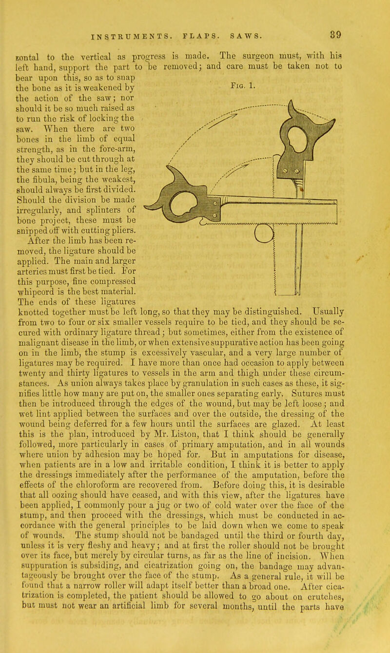 INSTRUMENTS. FLAPS. SAWS. Fig. 1. Eontal to the vertical as progress is made. The surgeon must, with his left hand, support the part to'^be removed; and care must be taken not to bear upon this, so as to snap the bone as it is weakened by the action of the saw; nor should it be so much raised as to run the risk of locking the saw. When there are two bones in the limb of equal strength, as in the fore-arm, they should be cut thi-ough at the same time; but in the leg, the fibula, being the weakest, should always be first divided. Should the division be made ii'regularly, and splinters of bone project, these must be snipped oif with cutting pliers. After the limb has been re- moved, the ligature should be applied. The main and larger arteries must first be tied. For this purpose, fine compressed whipcord is the best material. The ends of these ligatures knotted together must be left long, so that they may be distinguished. Usually from two to four or six smaller vessels require to be tied, and they should be se- cured with ordinary ligature thread; but sometimes, either from the existence of malignant disease in the limb, or when extensive suppurative action has been going on in the limb, the stump is excessively vascular, and a very large number of ligatures may be required. I have more than once had occasion to apply between twenty and thirty ligatures to vessels in the arm and thigh under these circum- stances. As union always takes place by granulation in such cases as these, it sig- nifies little how many are put on, the smaller ones separating eai'ly. Sutures must then be introduced through the edges of the wound, but may be left loose; and wet lint applied between the surfaces and over the outside, the dressing of the wound being deferred for a few hours until the surfaces are glazed. At least this is the plan, introduced by Mr. Liston, that I think should be generally followed, more particularly in cases of primary amputation, and in all wounds where union by adhesion may be hoped for. But in amputations for disease, when patients are in a low and irritable condition, I think it is better to apply the dressings immediately after the performance of the amputation, before the effects of the chloroform are recovered from. Before doing this, it is desirable that all oozing should have ceased, and with this view, after the ligatures have been applied, I commonly pour a jug or two of cold water over the face of the Btump, and then proceed with the dressings, which must be conducted in ac- cordance with the general principles to be laid down when we come to speak of wounds. The stump should not be bandaged until the third or fourth day, unless it is very fleshy and heavy; and at first the roller should not be brouglit over its face, but merely by circular turns, as far as the line of incision. When suppuration is subsiding, and cicatrization going on, the bandage may advan- tageously be brought over the face of the stump. As a general rule, it will be found that a narrow roller will adapt itself better than a broad one. After cica- trization is completed, the patient should be allowed to go about on crutches, but must not wear an artificial limb for several months, until the parts have