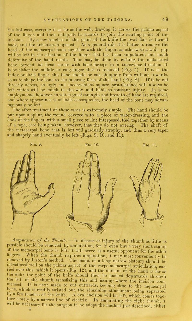 the last case, carrying it as far as the web, drawing it across the palmar aspect of the finger, and then obliquely backwards to join the starting-point of the incision. iBy a few touches of the point of the knife the oval flap is turned back, and the articulation opened. As a general rule it is better to remove the head of the metacarpal bone together with the finger, as otherwise a wide gap will be left in the situation of the finger that has been amputated, and much deformity of the hand result. This may be done by cutting the metacarpal bone beyond its head across with bone-forceps in a transverse direction, if it be either the middle or ring-finger that is removed (Fig. 7). If it is the index or little finger, the bone should be cut obliquely from without inwards, so as to shape the bone to the tapering form of the hand (Fig. 8). If it be cut directly across, an ugly and inconvenient square protuberance will always be left, which will be much in the way, and liable to constant injury. In some employments, however, in which great strength and breadth of hand are required, and where appearance is of little consequence, the head of the bone may advan- tageously be left. The after treatment of these cases is extremely simple. The hand should be put upon a splint, the wound covered with a piece of water-dressing, and the ends of the fingers, with a small piece of lint interposed, tied together by means of a tape, care being taken, however, that they do not overlap. The shaft of the metacarpal bone that is left will gradually atrophy, and thus a very taper and shapely hand eventually be left (Figs. 9, 10, and 11). Fig. 9. Fig. 10. Fig. 11. Amputation of tJie Thumb. — In disease or injury of the thumb as little as possible should be removed by amputation, for if even but a very short stump of the metacarpal bone is left, it will serve as a useful opponent for the other fingers. When the thumb requires amputation, it may most conveniently be removed by Listen's method. The point of a long narrow bistoury should be introduced well on the palmar aspect of the carpo-metacarpal articulation, ear- ned over this, which it opens (Fig. 12), and the dorsum of the hand as far as the web; the point of the knife should then be pushed downwards throu<;h the ball of the thumb, transfixing this and issuing where the incision com- menced. ^ It is next made to cut outwards, keeping close to the metacarpal hone, which is readily twisted out, the remaining attachment being separated by a few touches of the knife. A oval incision will be left, which comes toge- ther closely by a narrow line of cicatrix.' In amputating the right thumb, it will be necessary for the surgeon if he adopt the method just described, either 4