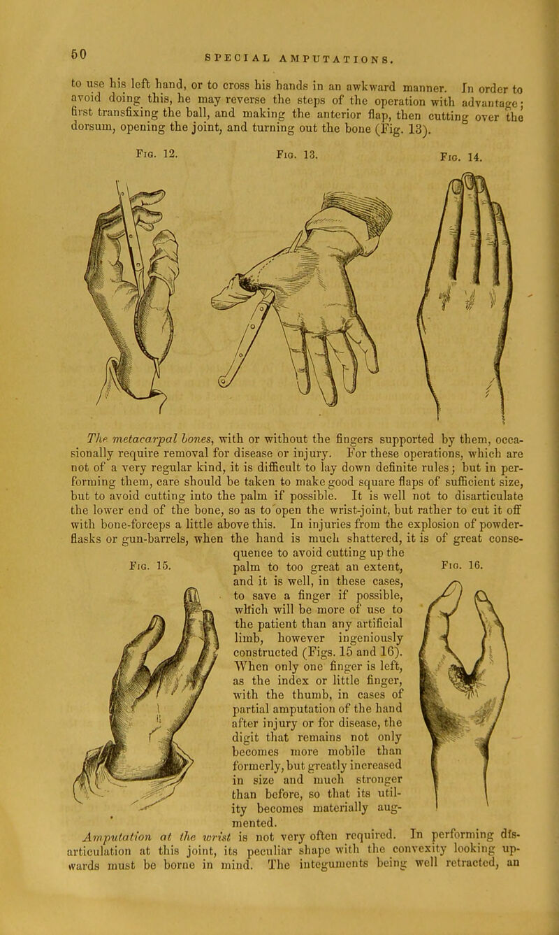 to use his left hand, or to cross his hands in an awkward manner. In order to avoid doing this, he may reverse the steps of the operation with advantage; first transfixing the ball, and making the anterior flap, then cutting over the dorsum, opening the joint, and turning out the bone (Fig. 13). Fig. 12. Fio. 13. Fio. 14. Fig. 15. Fig. 16. Thf metacarpal hones, with or without the fingers supported by them, occa- sionally require removal for disease or injury. For these operations, which are not of a very regular kind, it is difficult to lay down definite rules; but in per- forming them, care should be taken to make good square flaps of sufiicient size, but to avoid cutting into the palm if possible. It is well not to disarticulate the lower end of the bone, so as to open the wrist-joint, but rather to cut it off with bone-forceps a little above this. In injuries from the explosion of powder- flasks or gun-barrels, when the hand is much shattered, it is of great conse- quence to avoid cutting up the palm to too great an extent, and it is well, in these cases, to save a finger if possible, which will be more of use to the patient than any artificial limb, however ingeniously constructed (Figs. 15 and 16). when only one finger is left, as the index or little finger, with the thumb, in cases of partial amputation of the hand after injury or for disease, the digit that remains not only becomes more mobile than formerly, but greatly increased in size and much stronger than before, so that its util- ity becomes materially aug- mented. Amputation at the lurist is not very often required. In performing dfs- articulation at this joint, its peculiar shape with the convexity looking up- wards must be borne in mind. The integuments being well retracted, an