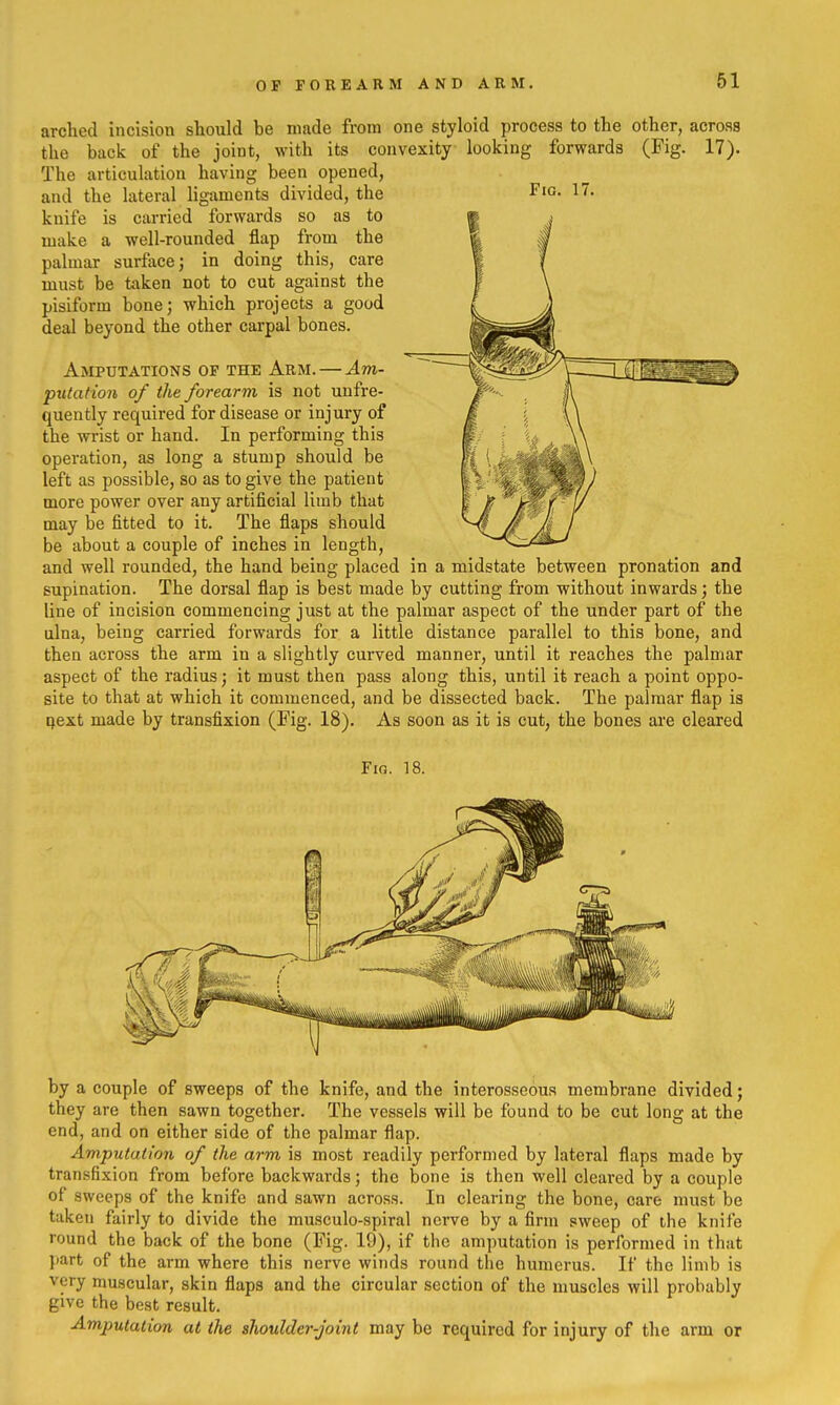 OF FOREARM AND ARM. 61 arched incision should be made from one styloid process to the other, across the back of the joint, with its convexity looking forwards (Fig. 17). The articulation having been opened, and the lateral ligaments divided, the Fio. 17. knife is carried forwards so as to make a well-rounded flap from the palmar surfxcej in doing this, care must be taken not to cut against the pisiform bone; which projects a good deal beyond the other carpal bones. Amputations of the Arm.—Am- putation, of the forearm is not unfre- quently required for disease or injury of the wrist or hand. In performing this operation, as long a stump should be left as possible, so as to give the patient more power over any artificial limb that may be fitted to it. The flaps should be about a couple of inches in length, and well rounded, the hand being placed in a midstate between pronation and supination. The dorsal flap is best made by cutting from without inwards; the line of incision commencing just at the palmar aspect of the under part of the ulna, being carried forwards for a little distance parallel to this bone, and then across the arm in a slightly curved manner, until it reaches the palmar aspect of the radius; it must then pass along this, until it reach a point oppo- site to that at which it commenced, and be dissected back. The palmar flap is tjext made by transfixion (Fig. 18). As soon as it is cut, the bones are cleared Fig. 18. by a couple of sweeps of the knife, and the interosseous membrane divided; they are then sawn together. The vessels will be found to be cut long at the end, and on either side of the palmar flap. Amputation of the arm is most readily performed by lateral flaps made by transfixion from before backwards; the bone is then well cleared by a couple of sweeps of the knife and sawn across. In clearing the bone, care must be taken fairly to divide the musculo-spiral nerve by a firm sweep of the knife round the back of the bone (Fig. 19), if the amputation is performed in that J»art of the arm where this nerve winds round the humerus. If the limb is very muscular, skin flaps and the circular section of the muscles will probably give the best result. Amputation at the shoulder-Joint may be required for injury of the arm or