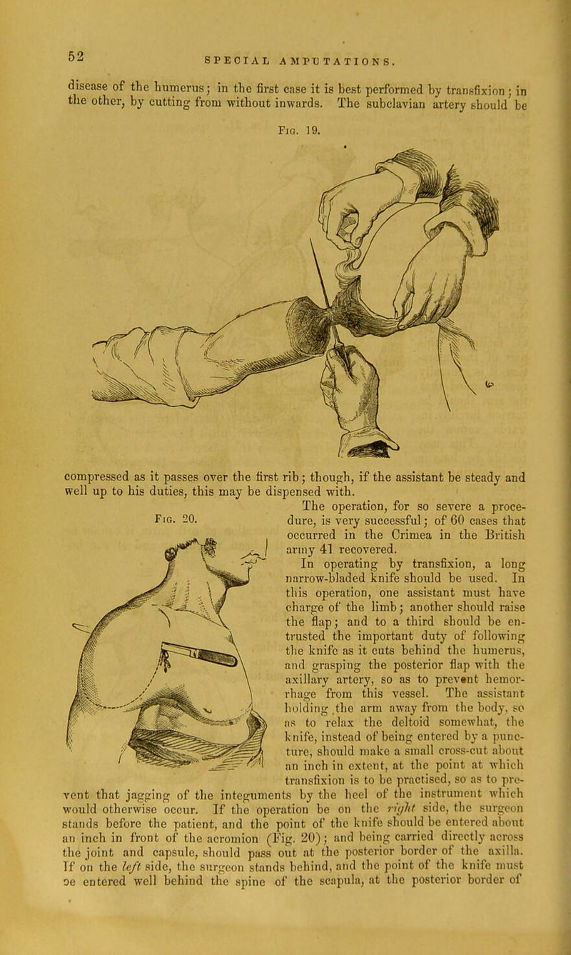 disease of the humerus; in the first case it is best performed by transfixion ; in tlie other, by cutting from without inwards. The subclavian artery should be Fia. 19. Fig. 20. compressed as it passes over the first rib; though, if the assistant be steady and well up to his duties, this may be dispensed with. The operation, for so severe a proce- dure, is very successful; of 60 cases that occurred in the Crimea in the British ariny 41 recovered. In operating by transfixion, a long narrow-bladed knife should be used. In this operation, one assistant must have charge of the limb; another should raise the flap; and to a third should be en- trusted the important duty of following the knife as it cuts behind the humerus, and grasping the posterior flap with the axillary artery, so as to prevent hemor- rhage from this vessel. The assistant holding the arm away from the body, so as to relax the deltoid somewhat, the knife, instead of being entered by a punc- ture, should make a small cross-cut about an inch in extent, at the point at which transfixion is to be practised, so as to pre- vent that jagging of the integuments by the heel of the instrument which would otherwise occur. If the operation be on tlic ri(iht side, the surgeon stands before the patient, and the point of the knife should be entered about an inch in front of the acromion (Fig. 20); and being carried directly across the joint and capsule, should pa.ss out at the posterior border of the axilla. If on the left side, the surgeon stands behind, and the point of the knife must oe entered well behind the spine of the scapula, at the posterior border of