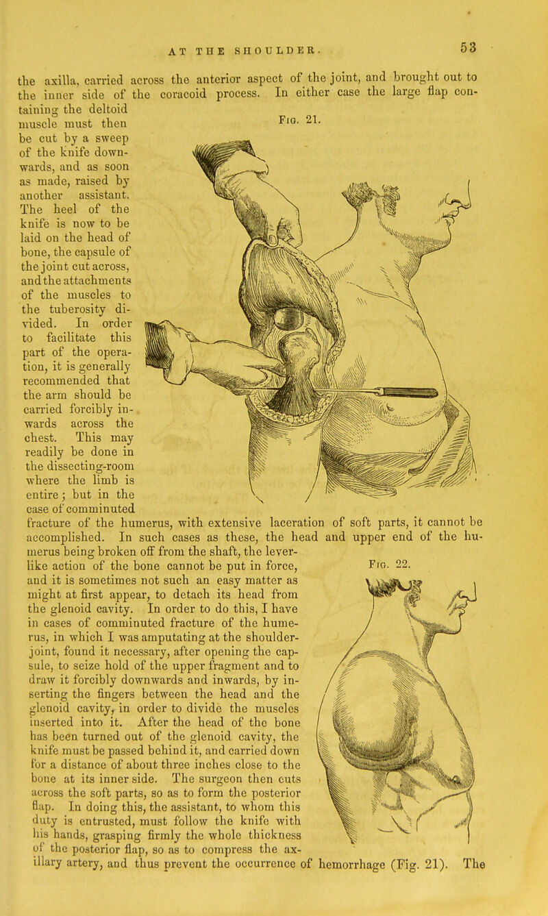 Fig. 21. the axilla, carried across the anterior aspect of the joint, and brought out to the inner side of the coracoid process. In either case the large flap con- taining the deltoid muscle must then be cut by a sweep of the knife down- wards, and as soon as made, raised by another assistant. The heel of the knife is now to be laid on the head of bone, the capsule of the joint cut across, and the attachments of the muscles to the tuberosity di- vided. In order to facilitate this part of the opera- tion, it is generally recommended that the arm should be carried forcibly in- wards across the chest. This may readily be done in the dissecting-room where the limb is entire; but in the case of comminuted fracture of the humerus, with extensive laceration of soft parts, it cannot be accomplished. In such cases as these, the head and upper end of the hu- merus being broken off from the shaft, the lever- like action of the bone cannot be put in force, and it is sometimes not such an easy matter as might at first appear, to detach its head from the glenoid cavity. In order to do this, I have in cases of comminuted fracture of the hume- rus, in which I was amputating at the shoulder- joint, found it necessary, after opening the cap- sule, to seize hold of the upper fragment and to draw it forcibly downwards and inwards, by in- serting the fingers between the head and the glenoid cavity, in order to divide the muscles inserted into it. After the head of the bone has been turned out of the glenoid cavity, the knife must be passed behind it, and carried down for a distance of about three inches close to the bone at its inner side. The surgeon tlien cuts across the soft parts, so as to form the posterior flap. In doing this, the assistant, to whom this duty is entrusted, must follow the knife with liis hands, grasping firmly the whole thickness of the posterior flap, so as to compress the ax- illary artery, and thus prevent the occurrence of hemorrhage (Fig. 21). The Fio. 22.