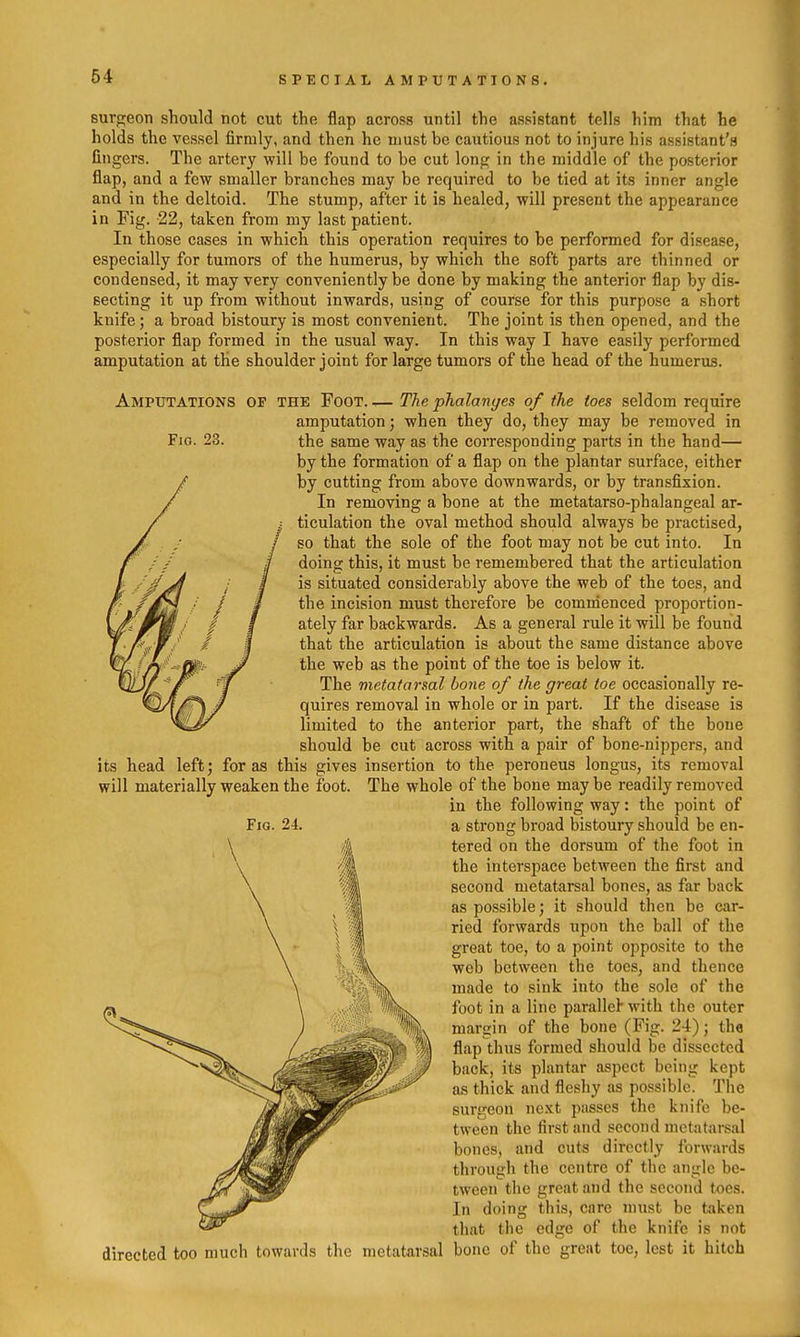 surgeon should not cut the flap across until the assistant tells him that he holds the vessel firmly, and then he must be cautious not to injure his assistant's fingers. The artery will be found to be cut long in the middle of the posterior flap, and a few smaller branches may be required to be tied at its inner angle and in the deltoid. The stump, after it is healed, will present the appearance in Fig. 22, taken from my last patient. In those cases in which this operation requires to be performed for disease, especially for tumors of the humerus, by which the soft parts are thinned or condensed, it may very conveniently be done by making the anterior flap by dis- secting it up from without inwards, using of course for this purpose a short knife; a broad bistoury is most convenient. The joint is then opened, and the posterior flap formed in the usual way. In this way I have easily performed amputation at the shoulder joint for large tumors of the head of the humerus. Amputations of the Foot. — The phalanges of the toes seldom require amputation; when they do, they may be removed in Fio. 23. the same way as the corresponding parts in the hand— by the formation of a flap on the plantar surface, either by cutting from above downwards, or by transfixion. In removing a bone at the metatarso-phalangeal ar- ticulation the oval method should always be practised, so that the sole of the foot may not be cut into. In doing this, it must be remembered that the articulation is situated considerably above the web of the toes, and the incision must therefore be comnienced proportion- ately far backwards. As a general rule it will be found that the articulation is about the same distance above the web as the point of the toe is below it. The metatarsal bone of the great toe occasionally re- quires removal in whole or in part. If the disease is limited to the anterior part, the shaft of the bone should be cut across with a pair of bone-nippers, and insertion to the peroneus longus, its removal The whole of the bone may be readily removed in the following way: the point of a strong broad bistoury should be en- tered on the dorsum of the foot in the interspace between the first and second metatarsal bones, as far back as possible; it should then be car- ried forwards upon the ball of the great toe, to a point opposite to the web between the toes, and thence made to sink into the sole of the foot in a line parallel with the outer margin of the bone (Fig. 24); the flap thus formed should be dissected back, its plantar aspect being kept as thick and fleshy as possible. The surgeon next passes the knife be- tween the first and second mctatai-sal bones, and cuts directly forwards through the centre of the angle be- tween the great and the second toes. In doing this, care must be taken that the edge of the knife is not directed too much towards the metatarsal bone of the great toe, lest it hitch its head left; for as this give will materially weaken the foot,