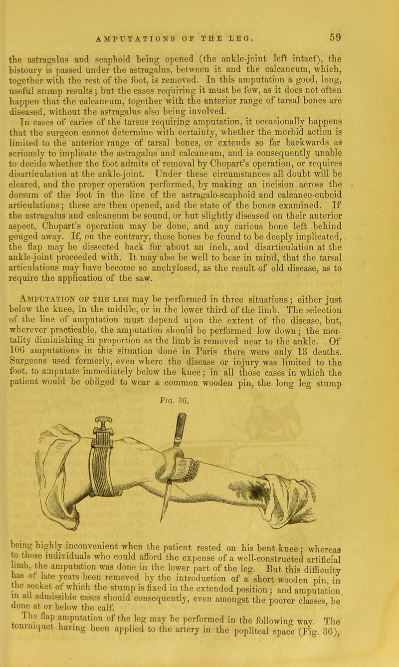 the astragalus and scaphoid being opened (the ankle-joint left intact), the bistoury is passed under the astragalus, between it and the calcaneum, which, together with the rest of the foot, is removed. In this amputation a good, long, useful Slump results; but the cases requiring it must be few, as it does not often happen that the calcaneum, together with the anterior range of tarsal bones are diseased, without the astragalus also being involved. In cases of caries of the tarsus requiring amputation, it occasionally happens that the surgeon cannot determine with certainty, whether the morbid action is limited to the anterior range of tarsal bones, or extends so far backwards as seriously to implicate the astragalus and calcaneum, and is consequently unable to decide whether the foot admits of removal by Chopart's operation, or requires disarticulation at the ankle-joint. Under these circumstances all doubt will be cleared, and the proper operation performed, by making an incision across the dorsum of the foot in the line of the astragalo-scaphoid and calcaneo-cuboid articulations; these are then opened, and the state of the bones examined. If the astragalus and calcaneum be sound, or but slightly diseased on their anterior aspect, Chopart's operation may be done, and any carious bone left behind gouged away. If, on the contrary, these bones be found to be deeply implicated, the flap may be dissected back for about an inch, and disarticulation at the ankle-joint proceeded with. It may also be well to bear in mind, that the tarsal articulations may have become so anchylosed, as the result of old disease, as to require the application of the saw. Amputation of the leg may be performed in three situations; either just below the knee, in the middle, or in the lower third of the limb. The selection of the line of amputation must depend upon the extent of the disease, but, wherever practicable, the amputation should be performed low down; the mor- tality diminishing in proportion as the limb is removed near to the ankle. Of 106 amputations in this situation done in Paris there were only 13 deaths. Surgeons used formerly, even where the disease or injury was limited to the foot, to amputate immediately below the knee; in all those cases in which the patient would be obliged to wear a common wooden pin, the long leg stump Fig. 36. being highly inconvenient when the patient rested on his bent knee; whereas to those individuals who could aflFord the expense of a well-constructed artificial limb, the amputation was done in the lower part of the leg. But this diflScuIty has of late years been removed by the introduction of a short wooden pin in the socket of which the stump is fixed in the extended position; and amputation in all admissible cases should consequently, even amongst the poorer classes, be done ut or below the calf The flap amputation of the leg may be performed in the following way. The tourniquet having been applied to the artery in the popliteal space (Fig. 36),