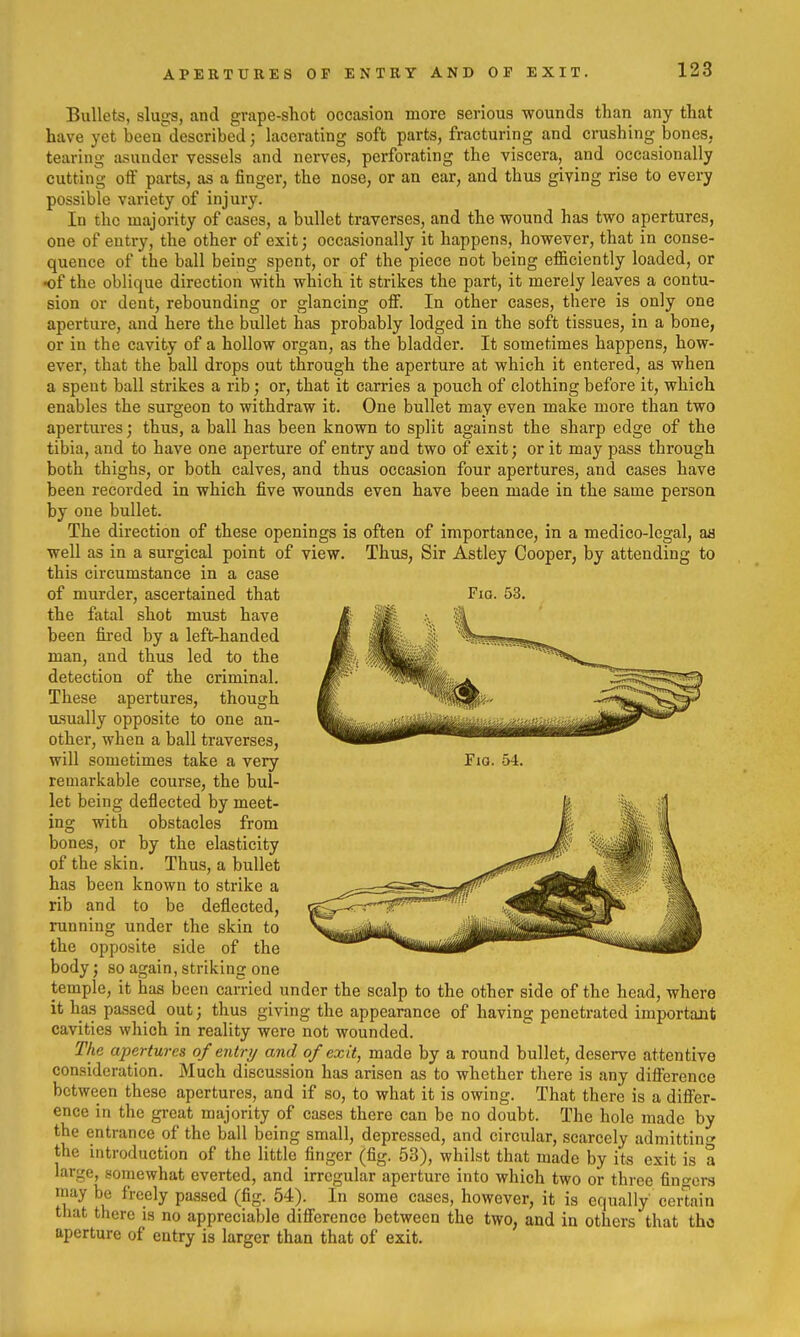 Bullets, slugs, and grape-shot occasion more serious wounds than any that have yet been described; lacerating soft parts, fracturing and crushing bones, tearing asunder vessels and nerves, perforating the viscera, and occasionally cutting off parts, as a finger, the nose, or an ear, and thus giving rise to every possible variety of injury. In the majority of cases, a bullet traverses, and the wound has two apertures, one of entry, the other of exit; occasionally it happens, however, that in conse- quence of the ball being spent, or of the piece not being efficiently loaded, or •of the oblique direction with which it strikes the part, it merely leaves a contu- sion or dent, rebounding or glancing off. In other cases, there is only one aperture, and here the bullet has probably lodged in the soft tissues, in a bone, or in the cavity of a hollow organ, as the bladder. It sometimes happens, how- ever, that the ball drops out through the aperture at which it entered, as when a spent ball strikes a rib; or, that it carries a pouch of clothing before it, which enables the surgeon to withdraw it. One bullet may even make more than two apertures j thus, a ball has been known to split against the sharp edge of the tibia, and to have one aperture of entry and two of exit; or it may pass through both thighs, or both calves, and thus occasion four apertures, and cases have been recorded in which five wounds even have been made in the same person by one bullet. The direction of these openings is often of importance, in a medico-legal, as well as in a surgical point of view. Thus, Sir Astley Cooper, by attending to this circumstance in a case of murder, ascertained that Fio. 53. the fatal shot must have been fii-ed by a left-handed man, and thus led to the detection of the criminal. These apertures, though usually opposite to one an- other, when a ball traverses, will sometimes take a very Fio. 54. remarkable course, the bul- let being deflected by meet- ing with obstacles from bones, or by the elasticity of the skin. Thus, a bullet has been known to strike a rib and to be deflected, running under the skin to the opposite side of the body; so again, striking one temple, it has been carried under the scalp to the other side of the head, where it has passed out; thus giving the appearance of having penetrated important cavities which in reality were not wounded. The apertures of entry and of exit, made by a round bullet, deserve attentive consideration. Much discussion has arisen as to whether there is any difference between these apertures, and if so, to what it is owing. That there is a differ- ence in the great majority of cases there can be no doubt. The hole made by the entrance of the ball being small, depressed, and circular, scarcely admitting the introduction of the little finger (fig. 53), whilst that made by its exit is a large, somewhat everted, and irregular aperture into which two or three fino-ors may be freely passed (fig. 54). In some cases, however, it is equally cei^ain that there is no appreciable difference between the two, and in others that the aperture of entry is larger than that of exit.