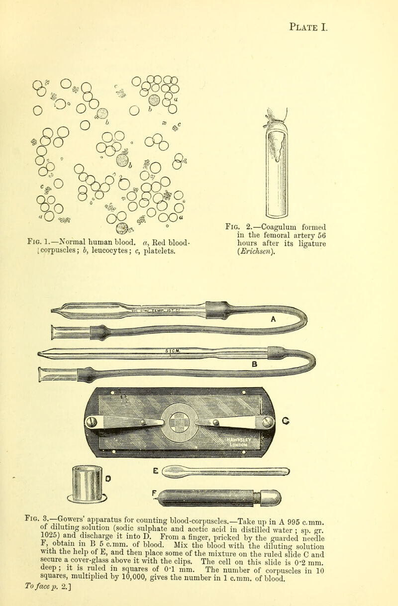 CP 4 CX) Fig. 1.—Normal human blood, a, Red blood- [corpuscles; b, leucocytes; c, platelets. Fig. 2.—Coagulum formed in the femoral artery 56 hours after its ligature (Eriehsen). f'~Tp°^erS' aPParatus for counting blood-corpuscles.—Take up in A 995 c.mm. oi diluting solution (sodic sulphate and acetic acid in distilled water ; sp. gr. 1025) and discharge it into D. From a finger, pricked by the guarded needle obtain m B 5 c.mm. of blood. Mix the blood with the diluting solution witn the help of E, and then place some of the mixture on the ruled slide C and secure a cover-glass above it with the clips. The cell on this slide is 0'2 mm. deep ; it is ruled in squares of O'l mm. The number of corpuscles in 10 squares, multiplied by 10,000, gives the number in 1 c.mm. of blood. To face p. 2.]