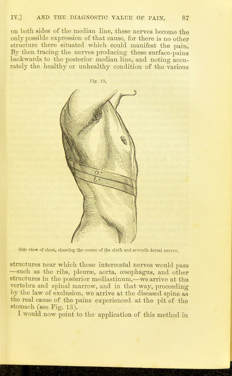 on botli sides of tlie median line, these nerves become the onlj^ possible expression of that cause, for there is no other structure there situated which could manifest the j^ain. By then tracing the nerves producing these surface-pains backwards to the posterior median line, and noting accu- rately the health}'- or unhealthy condition of the various Fig. 13. Side view of cliest, showing the course of the sixth and seventh dorsal nerves. structures near which these intercostal nei-ves would pass —such as the ribs, pleura?, aorta, oesophagus, and other structures in the posterior mediastinum,—we arrive at the vertebra and spinal marrow, and in that way, proceeding by the law of exclusion, we arrive at the diseased sjDine as the real cause of the pains experienced at the pit of the stomach (see Fig. 13). '. I would now point to the application of this method in