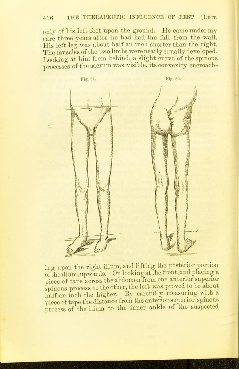 only of Hs left foot upon the ground. He came under my care three years after he had had the fall from the wall. His left leg was about half an inch shorter than the right. The muscles of the two limbs werenearly equally developed. Looking at him from behind, a slight curve of the spinous processes of the sacrum was visible, its convexity encroach- Fig. SI. Fig. 82. ino- upon the right ilium, and lifting the posterior portion oftheilium,upwards. On lookingatthe front.and placing a piece of tape across the abdomen from one anterior superior spinous process to the other, the left was proved to be about half an inch the higher. By carefully measuring with a piece of tape the distance from the anterior superior spinous process of the ilium to the inner ankle of the suspected