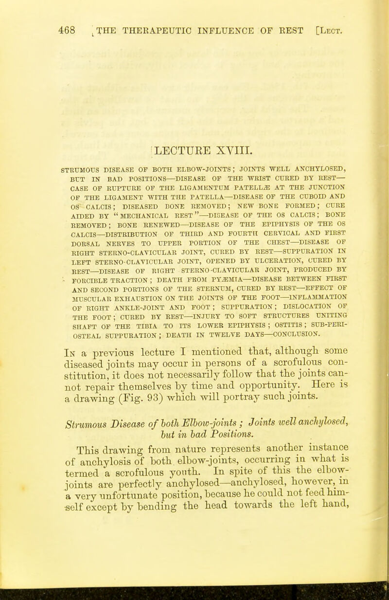 LECTUEE XVIII. STRUMOUS DISEASE OF BOTH ELBO-W-JOISTS ; JOINTS WELL ANCHYLOSED, BUT IN BAD POSITIONS—DISEASE OP THE WRIST CURED BY REST— CASE OP RUPTURE OP THE LIGAMENTUM PATELLA AT THE JUNCTION OP THE LIGAMENT WITH THE PATELLA—DISEASE OF THE CUBOID AND OS CALCIS; DISEASED DONE REMOVED; NEW BONE FORMED; CUBE AIDED BY MECHANICAL REST—DISEASE OF THE OS CALCIS; BONE REMOVED ; BONE RENEWED—DISEASE OP THE EPIPHYSIS OF THE OS CALCIS—DISTRIBUTION OP THIRD AND FOURTH CERVICAL AND FIRST DORSAL NERVES TO UPPER PORTION OP THE CHEST—DISEASE OP RIGHT STERNO-CLAVICULAR JOINT, CURED BY REST—SUPPURATION IN LEFT STERNO CLAVICULAR JOINT, OPENED BY ULCERATION, CUBED BY EEST—DISEASE OP RIGHT STERNO-CLAVICULAR JOINT, PRODUCED BY - FORCIBLE TRACTION ; DEATH PROM PYEMIA—DISEASE BETWEEN FIRST AND SECOND PORTIONS OF THE STERNUM, CURED BY REST—EFFECT OF MUSCULAR EXHAUSTION ON THE JOINTS OP THE FOOT—INFLAMMATION OF RIGHT ANKLE-JOINT AND FOOT ; SUPPURATION; DISLOCATION OF THE foot; CURED BY REST—INJURY TO SOFT STRUCTURES UNITING SHAFT OF THE TIBIA TO ITS LOWER EPIPHYSIS ; OSTITIS; SUB-PERI- OSTEAL SUPPURATION ; DEATH IN TWELVE DAYS—CONCLUSION. In a previous lecture I mentioned that, altliougli some diseased joints may occur in persons of a scrofulous con- stitution, it does not necessarily follow that the joints can- not repair themselves by time and opportunity. Here is a drawing (Fig. 93) which will portray such joints. Strumous Disease of both Elbow-joints ; Joints well anchjlosed, but in bad Positions. This drawing from nature represents another instance of anchylosis of both elbow-joints, occurring in what is termed a scrofulous youth. In spite of this the elbow- joints are perfectly anchylosed—anchylosed, however, m a very unfortunate position, because he could not feed him- self except by bending the head towards the left hand,