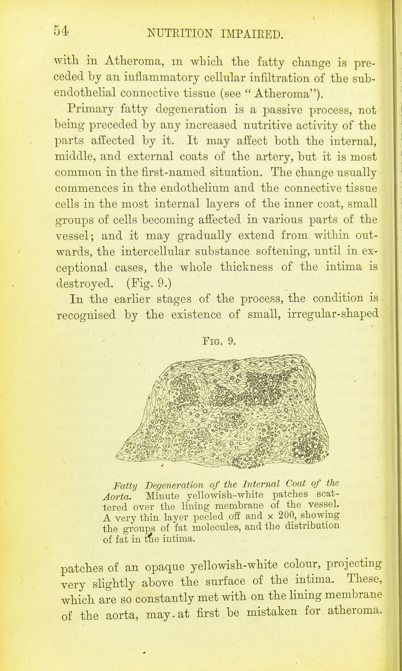 with in Atheroma, m which the fatty change is pre- ceded by an inflammatory cellular infiltration of the sub- endothelial connective tissue (see  Atheroma). Primary fatty degeneration is a passive process, not being preceded by any increased nutritive activity of the parts affected by it. It may affect both the internal, middle, and external coats of the artery, but it is most common in the first-named situation. The change usually commences in the endothelium and the connective tissue cells in the most internal layers of the inner coat, small groups of cells becoming affected in various parts of the vessel; and it may gradually extend from within out- wards, the intercellular substance softening, until in ex- ceptional cases, the whole thickness of the intima is destroyed. (Fig. 9.) In the earlier stages of the process, the condition is recognised by the existence of small, irregular-shaped Fig. 9. Fatty Degeneration of the Internal Coat of the Aorta. Minute yellowish-white patches scat- tered over the lining membrane of the vessel. A very thin layer peeled off and x 200, showing the groups of fat molecules, and the distribution of fat in the intima. patches of an opaque yellowish-white colour, projecting very slightly above the surface of the intima. These, which are so constantly met with on the lining membrane of the aorta, may. at first be mistaken for atheroma.