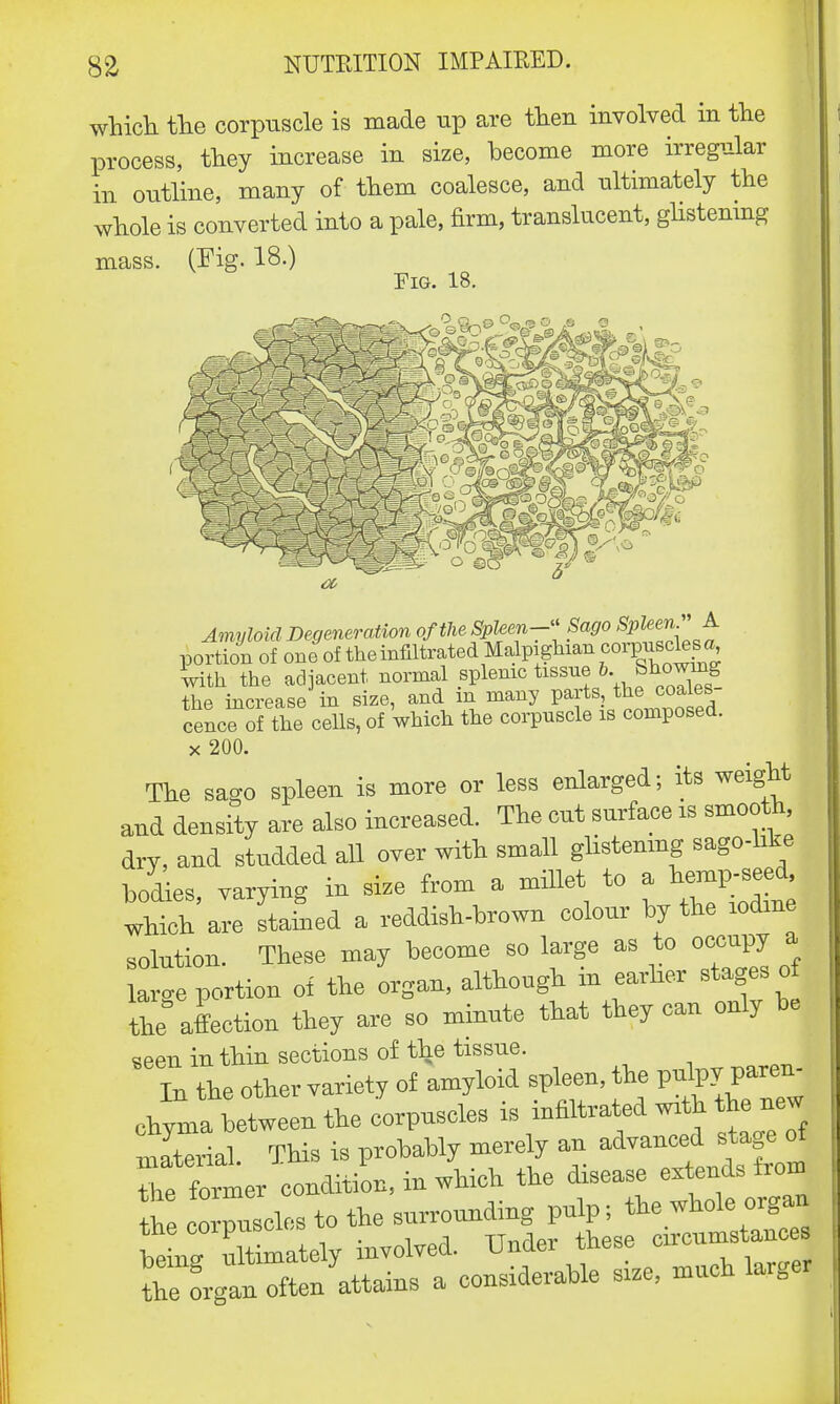 which the corpuscle is made up are then involved in the process, they increase in size, become more irregular in outline, many of them coalesce, and ultimately the whole is converted into a pale, firm, translucent, glistening mass. (Fig. 18.) Fig. 18. Amyloid Degeneration of the SpUen- Sago Spleen A portion of one>of the infiltrated Malpaghian corpuscles a with the adjacent normal splenic tissue 6. the increase in size, and m many parts the coales cence of the cells, of which the corpuscle is composed, x 200. The sago spleen is more or less enlarged; its weight and density are also increased. The cut surface is smooth, dry, and studded all over with small glistening sago-like bodies, varying in size from a millet to a hempW which are stained a reddish-brown colour by the iodine solution. These may become so large as to occupy a Le portion of the organ, although in earlier stages of the* affection they are so minute that they can only be seen in thin sections of the tissue. In the other variety of amyloid spleen, the pulps^ paren- chyma between the corpuscles is infiltrated w*h h new material This is probably merely an advanced stage ot X former condition, in which the disease extends from the iscles to the surrounding pulp; the whole organ S tately involved. Under these ™^ the organ often attains a considerable size, much larger