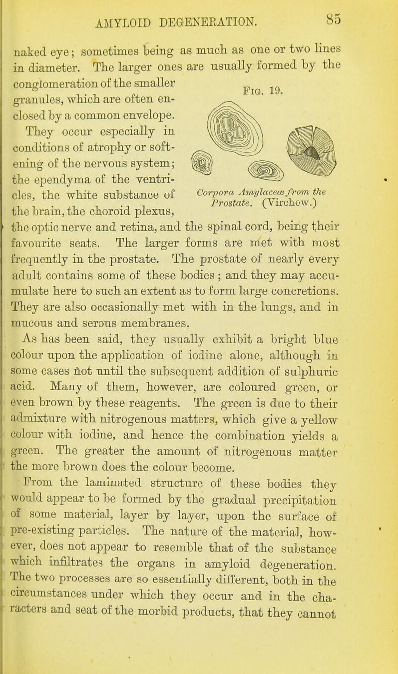 naked eye; sometimes being as much as one or two lines in diameter. The larger ones are usually formed by the conglomeration of the smaller granules, which are often en- closed by a common envelope. They occur especially in conditions of atrophy or soft- ening of the nervous system; the ependyma of the ventri- cles, the white substance of the brain, the choroid plexus, the optic nerve and retina, and the spinal cord, being their favourite seats. The larger forms are met with most frequently in the prostate. The prostate of nearly every adult contains some of these bodies ; and they may accu- mulate here to such an extent as to form large concretions. They are also occasionally met with in the lungs, and in mucous and serous membranes. As has been said, they usually exhibit a bright blue colour upon the application of iodine alone, although in some cases not until the subsequent addition of sulphuric acid. Many of them, however, are coloured green, or even brown by these reagents. The green is due to their admixture with nitrogenous matters, which give a yellow colour with iodine, and hence the combination yields a green. The greater the amount of nitrogenous matter the more brown does the colour become. From the laminated structure of these bodies they would appear to be formed by the gradual precipitation of some material, layer by layer, upon the surface of pre-existing particles. The nature of the material, how- ever, does not appear to resemble that of the substance which infiltrates the organs in amyloid degeneration. The two processes are so essentially different, both in the circumstances under which they occur and in the cha- racters and seat of the morbid products, that they cannot Fig. 19. Corpora Amylacece from the Prostate. (Virchow.)