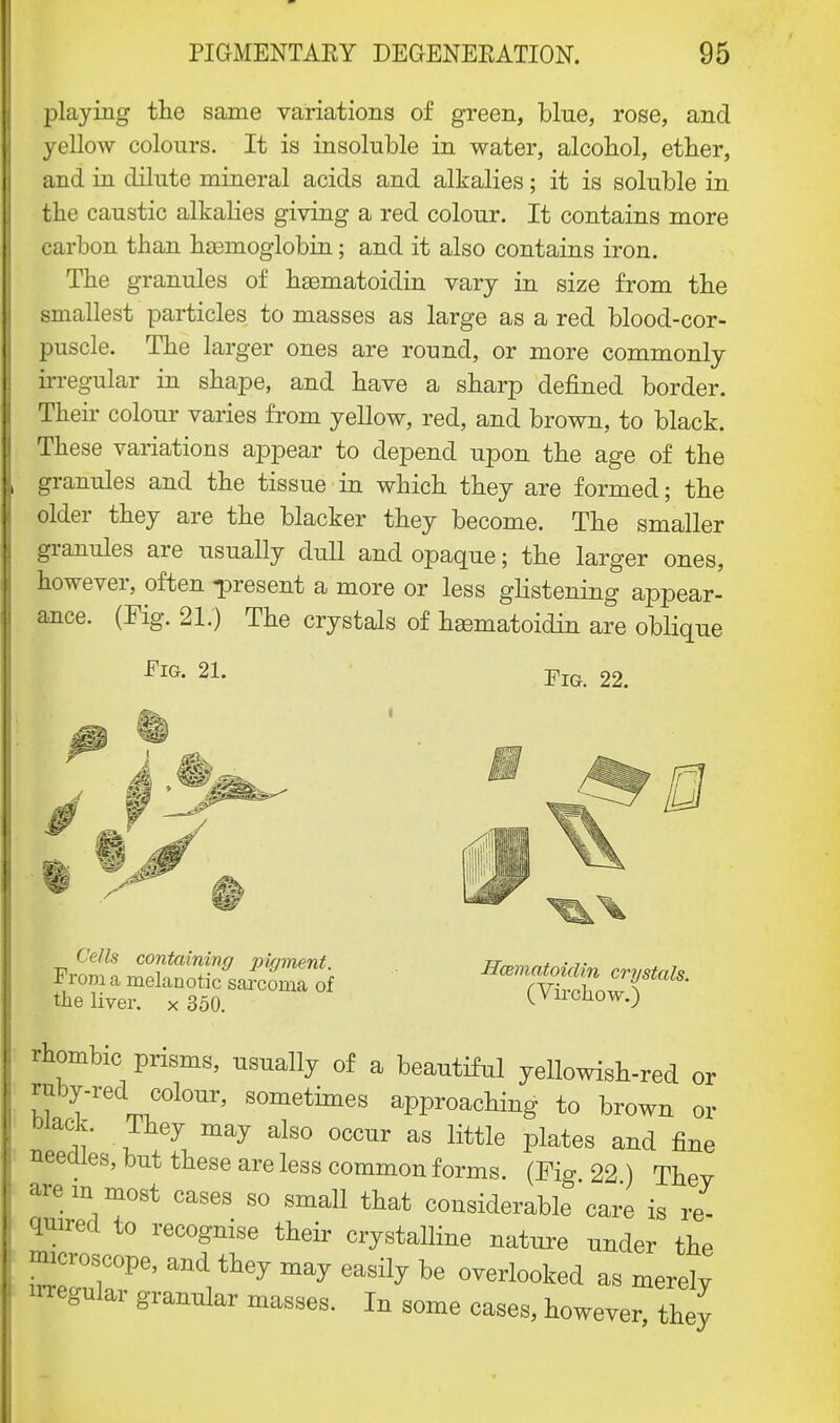 playing the same variations of green, blue, rose, and yellow colours. It is insoluble in water, alcohol, ether, and in dilute mineral acids and alkalies; it is soluble in the caustic alkalies giving a red colour. It contains more carbon than haemoglobin; and it also contains iron. The granules of haematoidin vary in size from the smallest particles to masses as large as a red blood-cor- puscle. The larger ones are round, or more commonly irregular in shape, and have a sharp defined border. Their colour varies from yellow, red, and brown, to black. These variations appear to depend upon the age of the granules and the tissue in which they are formed; the older they are the blacker they become. The smaller granules are usually dull and opaque; the larger ones, however, often -present a more or less glistening appear- ance. (Fig. 21.) The crystals of haematoidin are oblique Fig. 21. Fig. 22. Cells containing pigment. From a melanotic sarcoma of the liver. x 350. HcBinatoidin crystals. (Vircliow.) rhombic prisms, usually of a beautiful yellowish-red or ruby-red colour, sometimes approaching to brown or wack. They may also occur as little plates and fine needles, but these are less common forms. (Fig 22) Thev are in most cases so small that considerable care is re- quired to recognise their crystalline nature under the nncroscope, and they may easily be overlooked as merelv regular granular masses. In some cases, however they