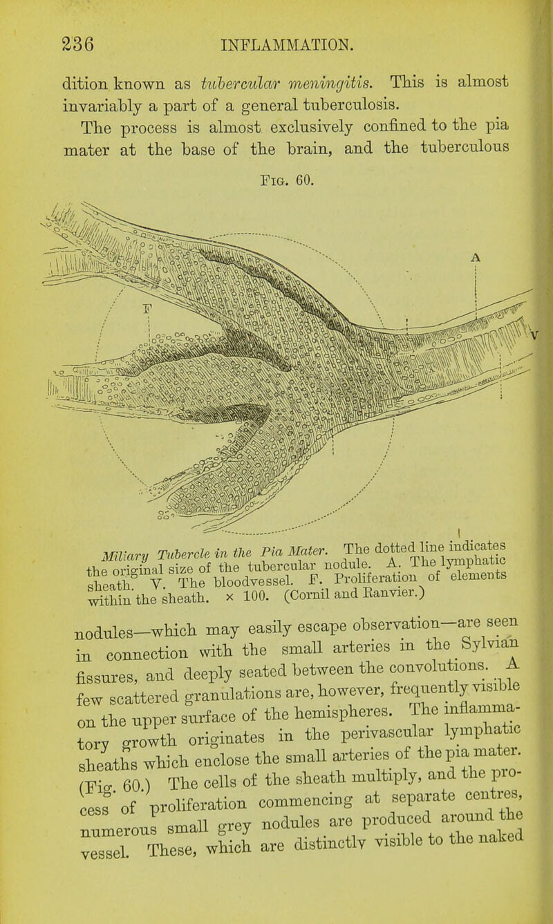 dition known as tubercular meningitis. This is almost invariably a part of a general tuberculosis. The process is almost exclusively confined to the pia mater at the base of the brain, and the tuberculous Fig. 60. Miliary Tubercle in the Pia Mater. The dottecI line, Mcates thp original size of the tubercular nodule. A. lhe lpnptiatic sheath V The bloodvessel. F. Proliferation of elements Sin the sheath, x 100. (Cornil and Eanvier.) nodules-which may easily escape observation-are seen m connection with the small arteries m the Sylvian fissures, and deeply seated between the convolutions. A few scattered granulations are, however, frequently visib e on the upper surface of the hemispheres. The inflamma- tory growth originates in the perivascular lymphatic sheaths which enclose the small arteries of thepiamate, fFi* 60 ) The cells of the sheath multiply, and the pro- cess of proliferation commencing at separate centres numeroJ small grey nodules are produced around the vessel These, which are distinctlv visible to the naked