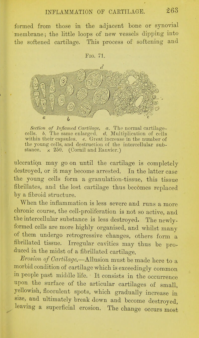 formed from those in the adjacent bone or synovial membrane; the little loops of new vessels dipping into the softened cartilage. This process of softening and Fig. 71. Section of Inflamed Cartilage, a. The. normal cartilage- cells, b. The same enlarged, d. Multiplication of cells within their capsules, e. Great increase in the number of the young cells, and destruction of the intercellular sub- stance, x 250. (Oomil and Eanvier.) ulceration may go on nntil the cartilage is completel}'- destroyed, or it may become arrested. In the latter case the young cells form a granulation-tissue, this tissue fibrillates, and the lost cartilage thus becomes replaced by a fibroid structure. When the inflammation is less severe and runs a more chronic course, the cell-proliferation is not so active, and the intercellular substance is less destroyed. The newly- formed cells are more highly organised, and whilst many of them undergo retrogressive changes, others form a fibrillated tissue. Irregular cavities may thus be pro- duced in the midst of a fibrillated cartilage. Erosion of Cartilage— Allusion must be made here to a morbid condition of cartilage which is exceedingly common in people past middle life. It consists in the occurrence upon the surface of the articular cartilages of small, yellowish, flocculent spots, which gradually increase in size, and ultimately break down and become destroyed, leaving a superficial erosion. The change occurs most