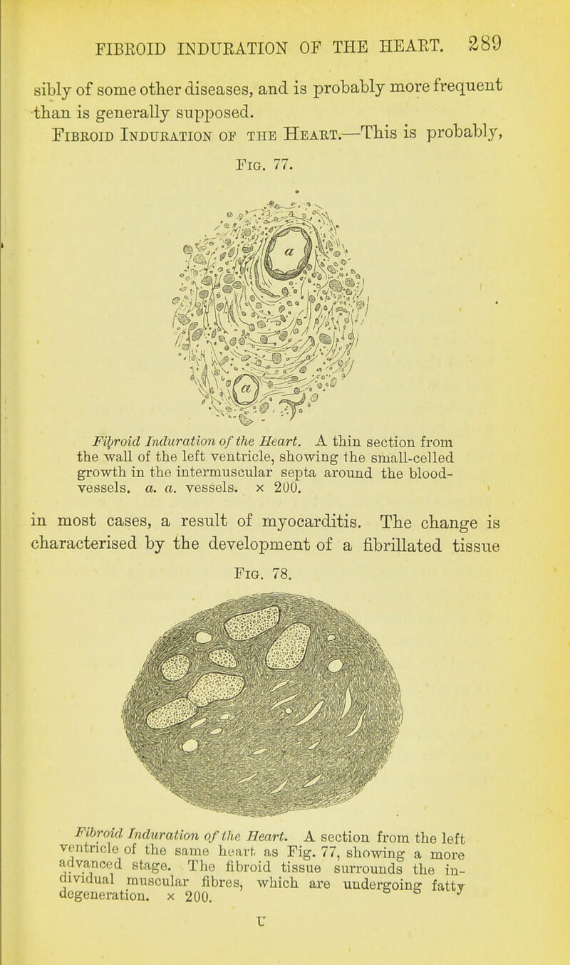 sibly of some other diseases, and is probably more frequent than is generally supposed. Fibroid Induration oe the Heart.—This is probably, Fig. 77. '0 J Fibroid Induration of the Heart. A thin section from the wall of the left ventricle, showing the small-celled growth in the intermuscular septa around the blood- vessels, a. a. vessels, x 2U0. in most cases, a result of myocarditis. The change is characterised by the development of a fibrillated tissue Fig. 78. Fibroid Induration of the Heart. A section from the left v<utricle of the same heart as Fig. 77, showing a more advanced stage. The fibroid tissue surrounds the in- dividual muscular fibres, which are undergoing fattv degeneration, x 200. J U