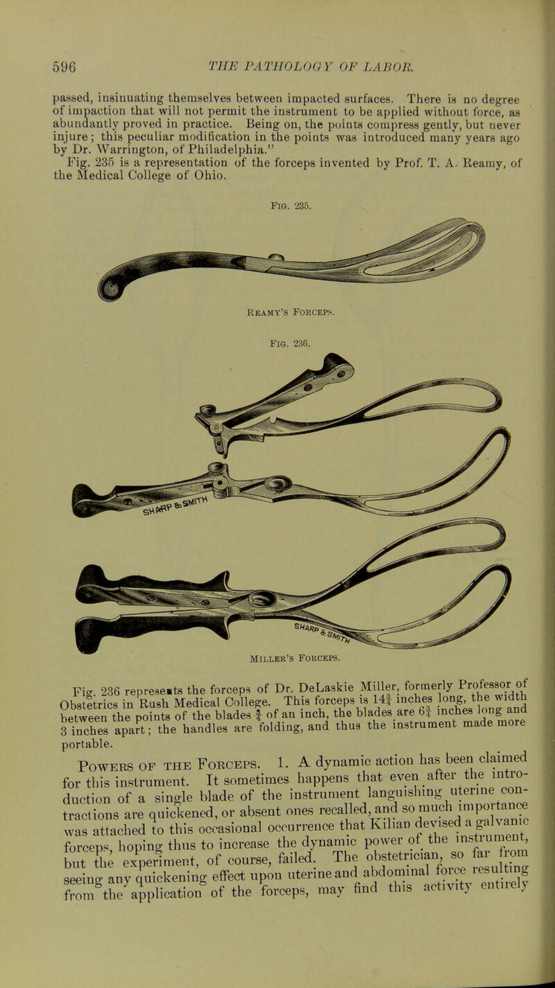 passed, insinuating themselves between impacted surfaces. There ia no degree of impaction that will not permit the instrument to be applied without force, as abundantly proved in practice. Being on, the points compress gently, but never injure ; this peculiar modification in the points was introduced many years ago by Dr. Warrington, of Philadelphia. Fig. 235 is a representation of the forceps invented by Prof. T. A. Reamy, of the Medical College of Ohio. Fig. 235. Reamy's Forceps. Fig. 236. Miller's Forceps. Fie 236 represents the forceps of Dr. DeLaskie Miller, formerly Professor of Obstetrics in Rush Medical College This forceps is 14| inches long, the width between the points of the blades * of an inch the blades are 6| inches long and 3 inches apart; the handles are folding, and thus the instrument made more portable. Powers of the Forceps. 1. A dynamic action has been claimed for this instrument. It sometimes happens that even after the intro- duction of a single blade of the instrument languishing utenne con- tractions are quickened, or absent ones recalled and so much importance was attached to this occasional occurrence that d^^™« forces hopino- thus to increase the dynamic power of the instrument, but the experiment, of course, failed.. The obstetrician^ so ar rom seeing any quickening effect upon uterine and abdominal foice resulting fmmgtheyapplication of the forceps, may find this activity entirely