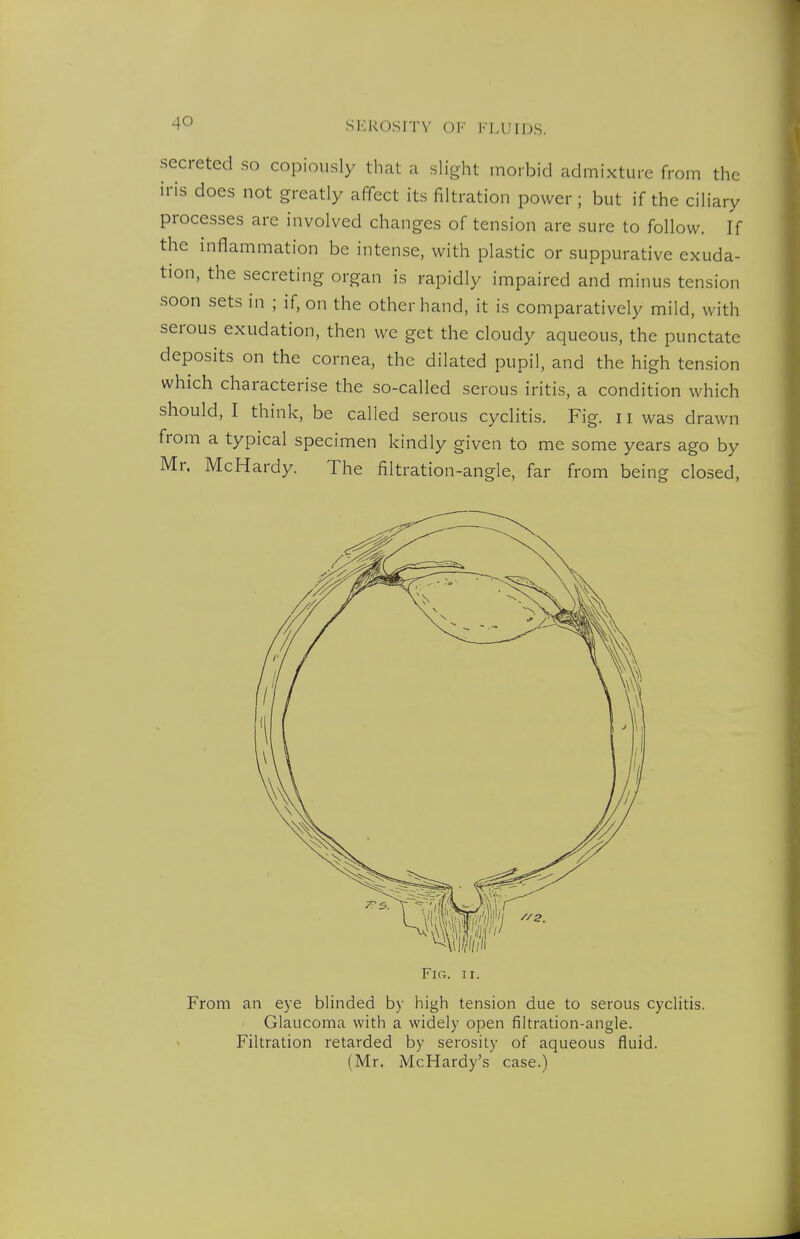 secreted so copiously that a slight morbid admixture from the iris does not greatly affect its filtration power; but if the ciliary processes are involved changes of tension are sure to follow. If the inflammation be intense, with plastic or suppurative exuda- tion, the secreting organ is rapidly impaired and minus tension soon sets in ; if, on the other hand, it is comparatively mild, with serous exudation, then we get the cloudy aqueous, the punctate deposits on the cornea, the dilated pupil, and the high tension which characterise the so-called serous iritis, a condition which should, I think, be called serous cyclitis. Fig. ii was drawn from a typical specimen kindly given to me some years ago by Mr. McHardy. The filtration-angle, far from being closed, From an eye blinded by high tension due to serous cyclitis. Glaucoma with a widely open filtration-angle. Filtration retarded by serosity of aqueous fluid. (Mr. McHardy's case.)