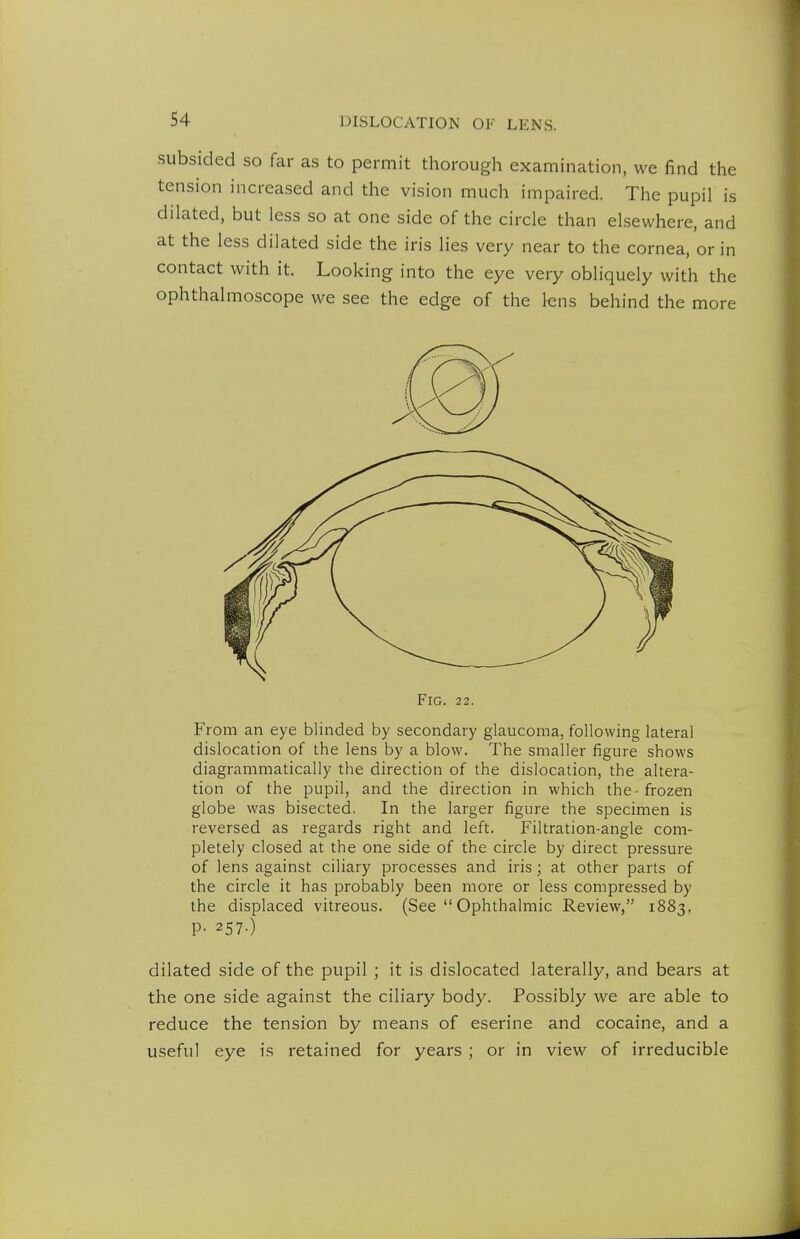 subsided so far as to permit thorough examination, we find the tension increased and the vision much impaired. The pupil is dilated, but less so at one side of the circle than elsewhere, and at the less dilated side the iris lies very near to the cornea, or in contact with it. Looking into the eye very obliquely with the ophthalmoscope we see the edge of the lens behind the more Fig. 22. From an eye blinded by secondary glaucoma, following lateral dislocation of the lens by a blow. The smaller figure shows diagrammatically the direction of the dislocation, the altera- tion of the pupil, and the direction in which the-frozen globe was bisected. In the larger figure the specimen is reversed as regards right and left. Filtration-angle com- pletely closed at the one side of the circle by direct pressure of lens against ciliary processes and iris; at other parts of the circle it has probably been more or less compressed by the displaced vitreous. (See  Ophthalmic Review, 1883, P- 257-) dilated side of the pupil ; it is dislocated laterally, and bears at the one side against the ciliary body. Possibly we are able to reduce the tension by means of eserine and cocaine, and a useful eye is retained for years ; or in view of irreducible