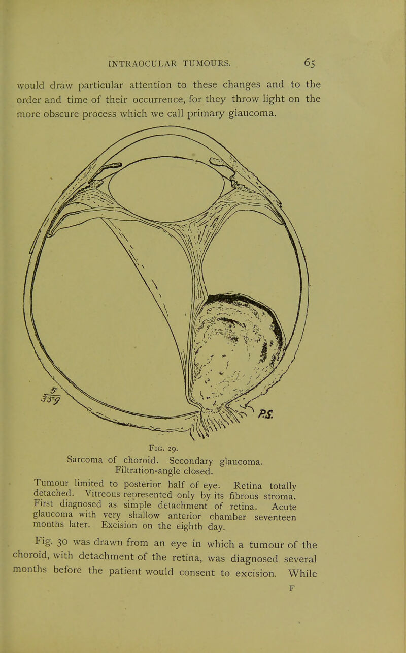 would draw particular attention to these changes and to the order and time of their occurrence, for they throw h'ght on the more obscure process which we call primary glaucoma. Fig. 29. Sarcoma of choroid. Secondary glaucoma. Filtration-angle closed. Tumour limited to posterior half of eye. Retina totally detached. Vitreous represented only by its fibrous stroma. First diagnosed as simple detachment of retina. Acute glaucoma with very shallow anterior chamber seventeen months later. Excision on the eighth day. Fig. 30 was drawn from an eye in which a tumour of the choroid, with detachment of the retina, was diagnosed several months before the patient would consent to excision. While F